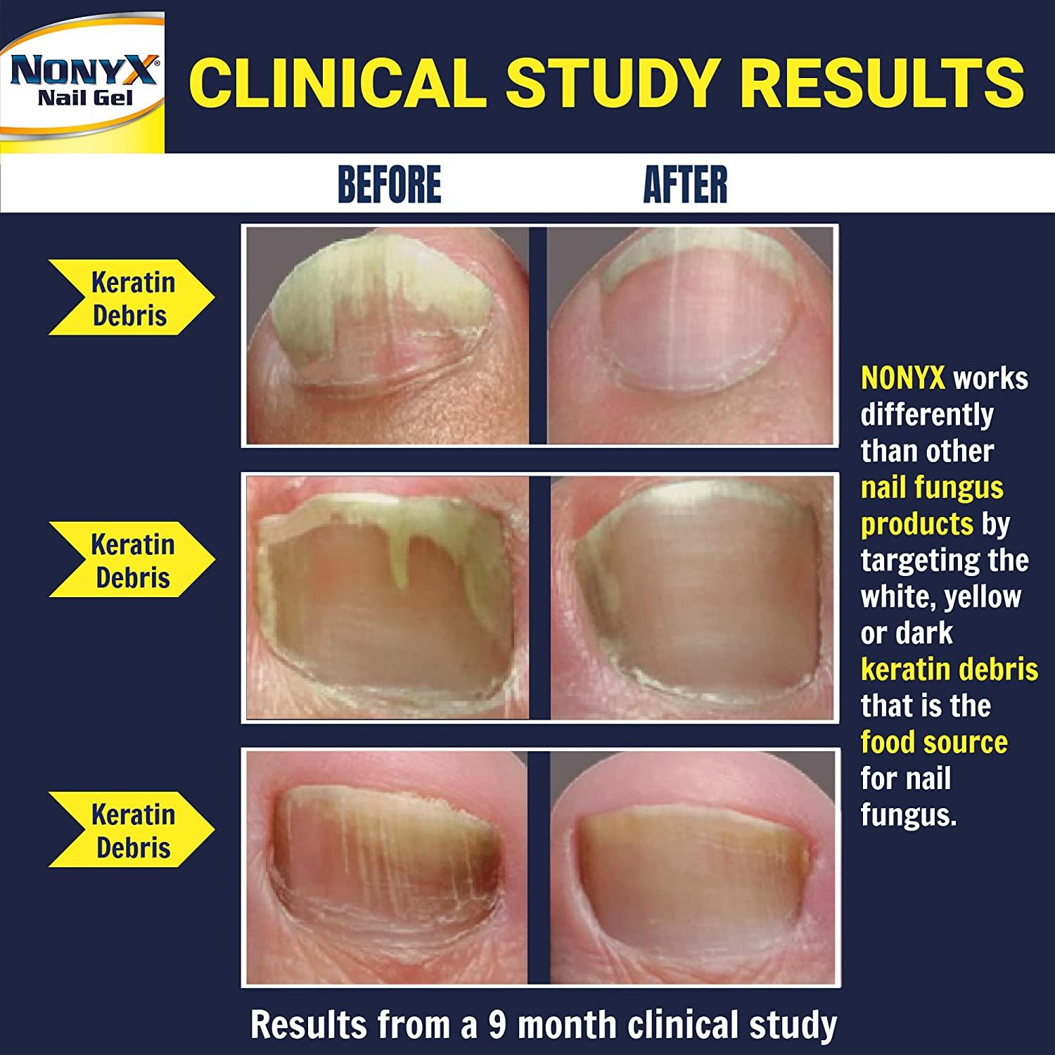 NONYX Nail Gel, a Toenail Fungus Treatment that Clears out Fungus by  Removing Keratin Debris where Nail Fungus Grows, 90% of Nails Improve, 4 fl  oz