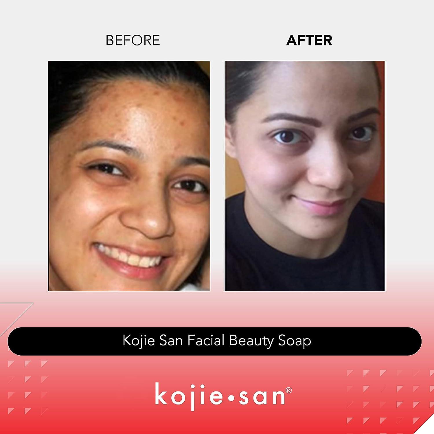 Kojie San Soap Before And After