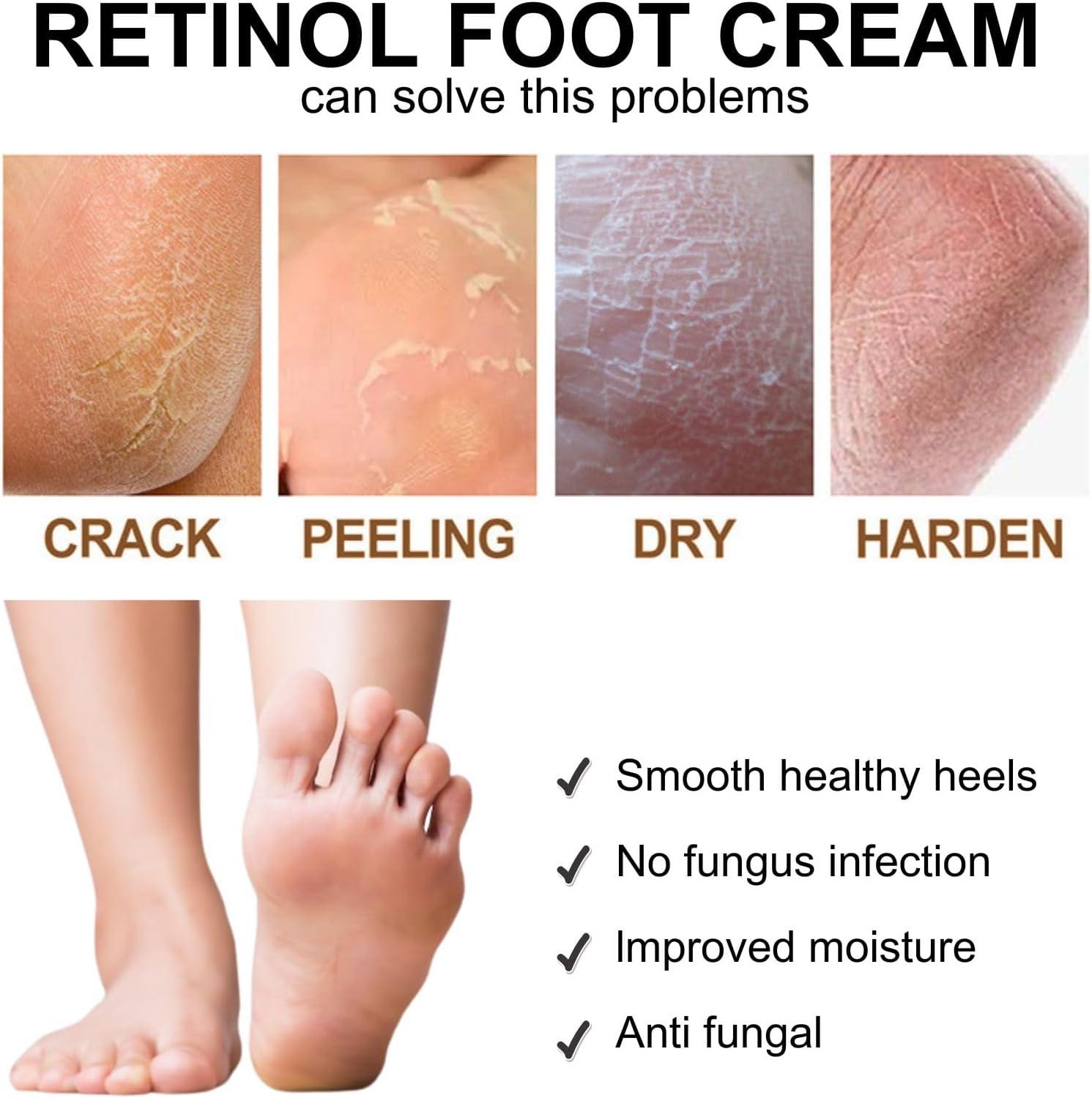 IZBEAUVO Retinol Foot Cream For Dry Cracked Feet Athletes Foot