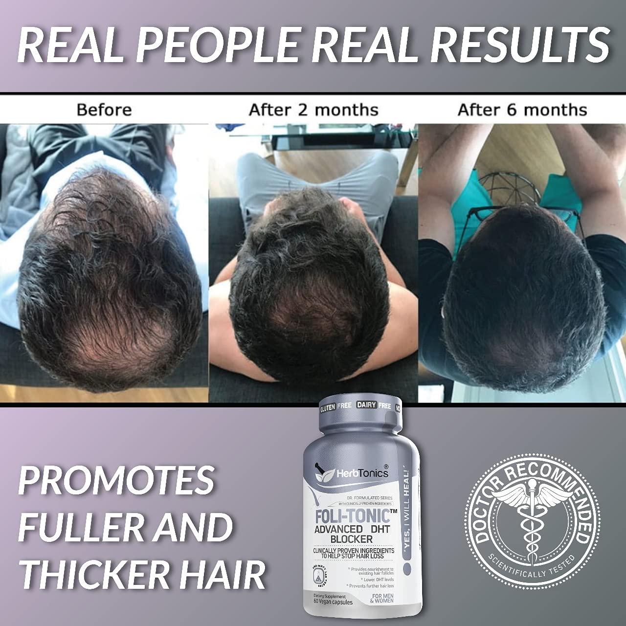 Herbtonics Foli-Tonic DHT Blocker To Stop Hair Loss Hair Thinning & Help  Thicker Hair Growth