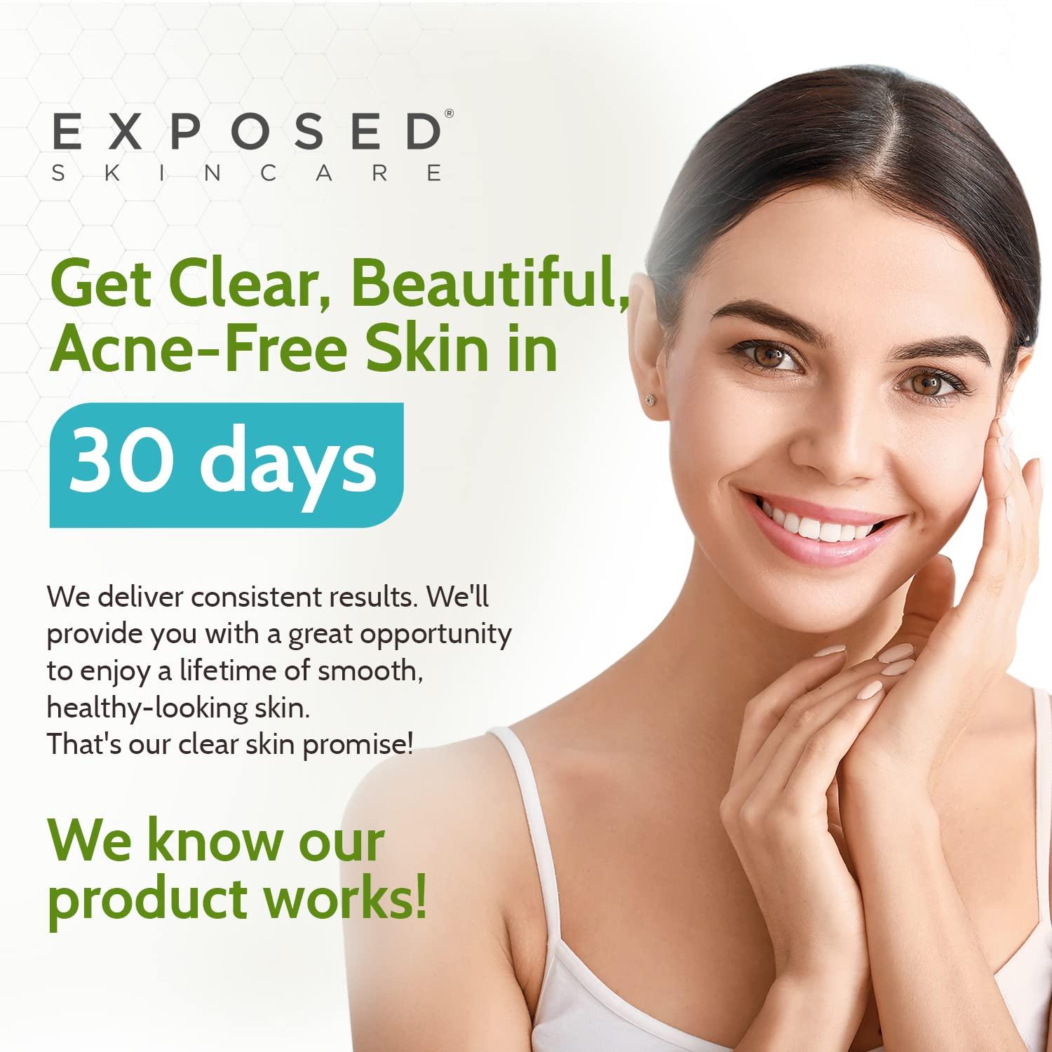 Exposed Skin Care Basic Acne Treatment Kit Includes Salicylic Acid