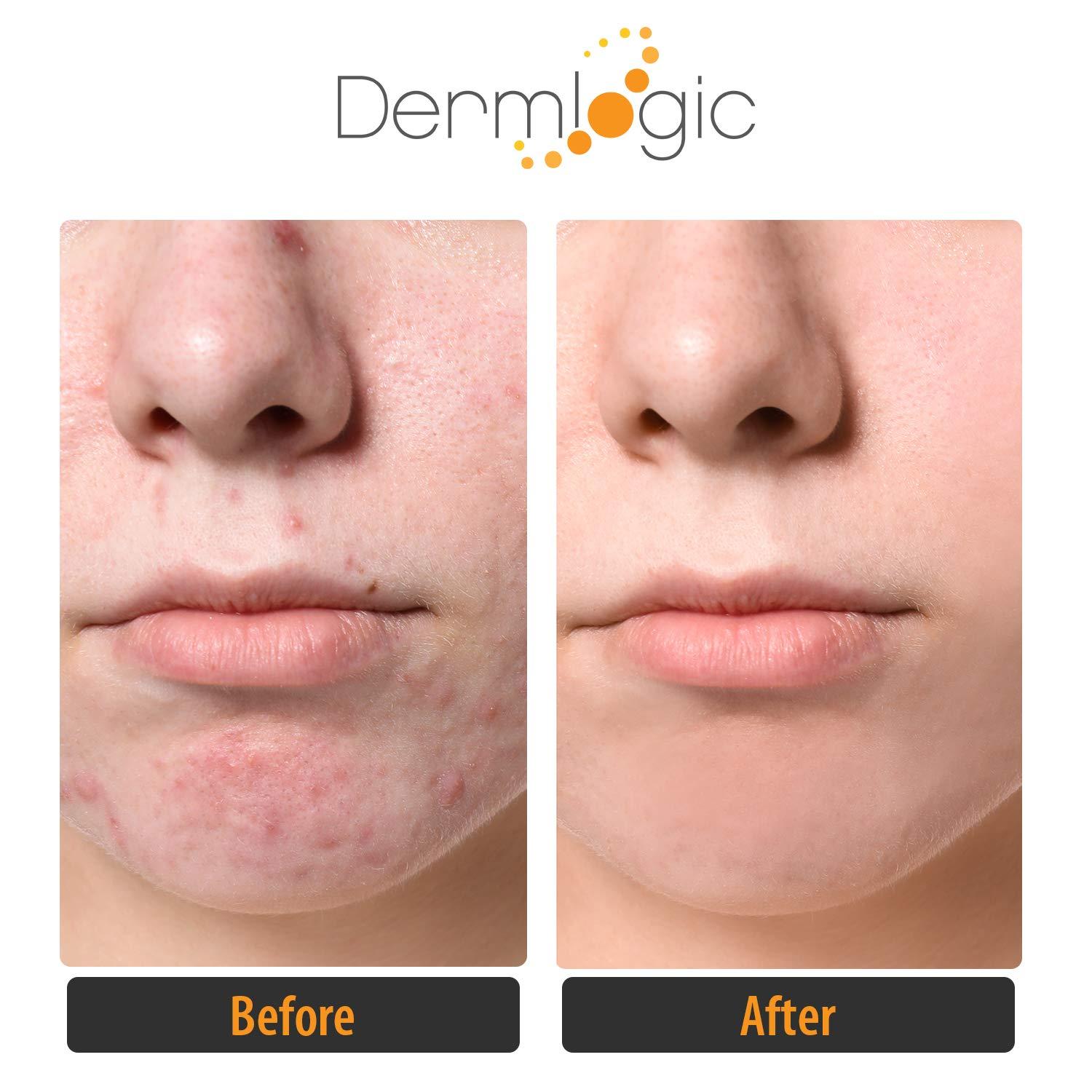 Dermlogic Acne Treatment PadsContains Glycolic, Lactic, Salicylic Acid