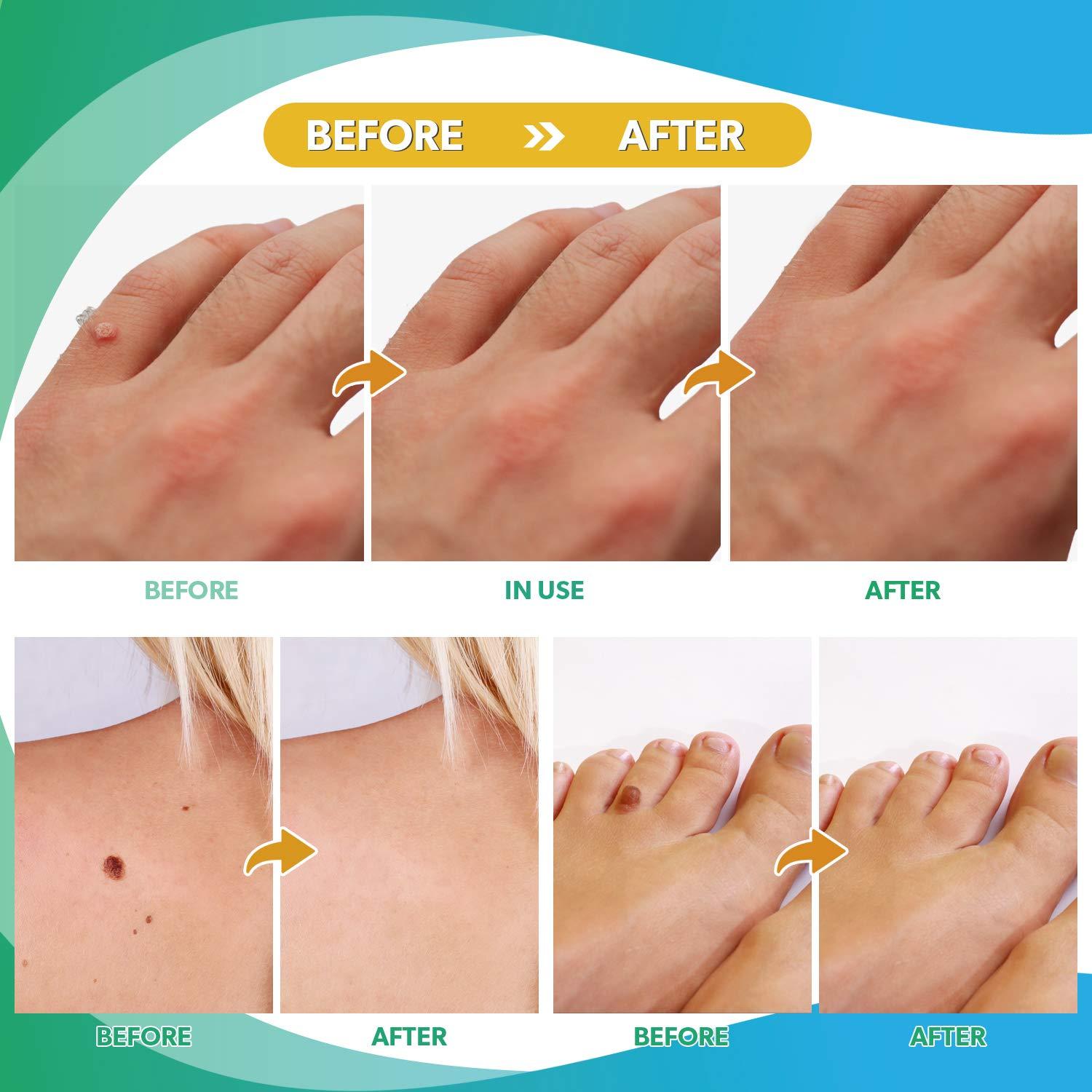 Ulensy 42pcs Skin Tag Remover Pads, FastActing, Comfortable Skin Tag Removal Treatment, Easy to