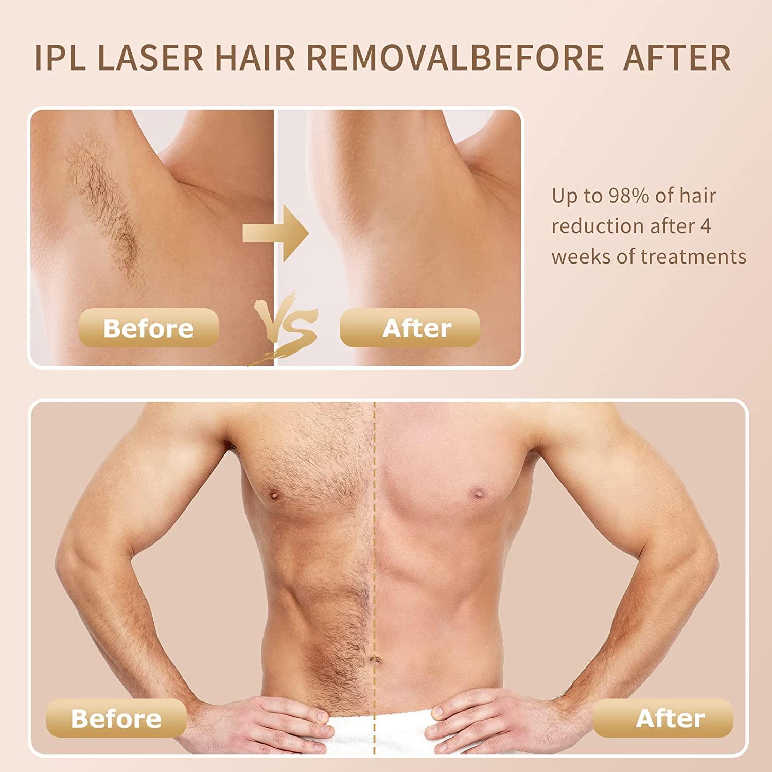 Laser Hair removal for Women Permanent at Home Ipl Hair Removal with Ice  Cooling Function Painless Hair Remover Device for Face Armpits Legs Arms  Bikini Line Upgraded to 999,900 Flashes Rose Gold