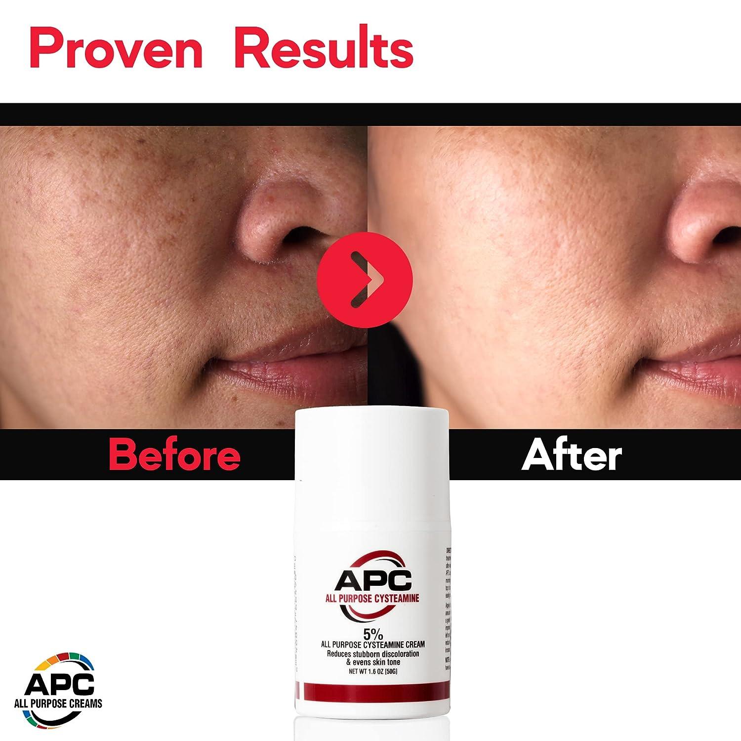 5 Cysteamine Cream 50ml Spot Correction Cream for Melasma Uneven