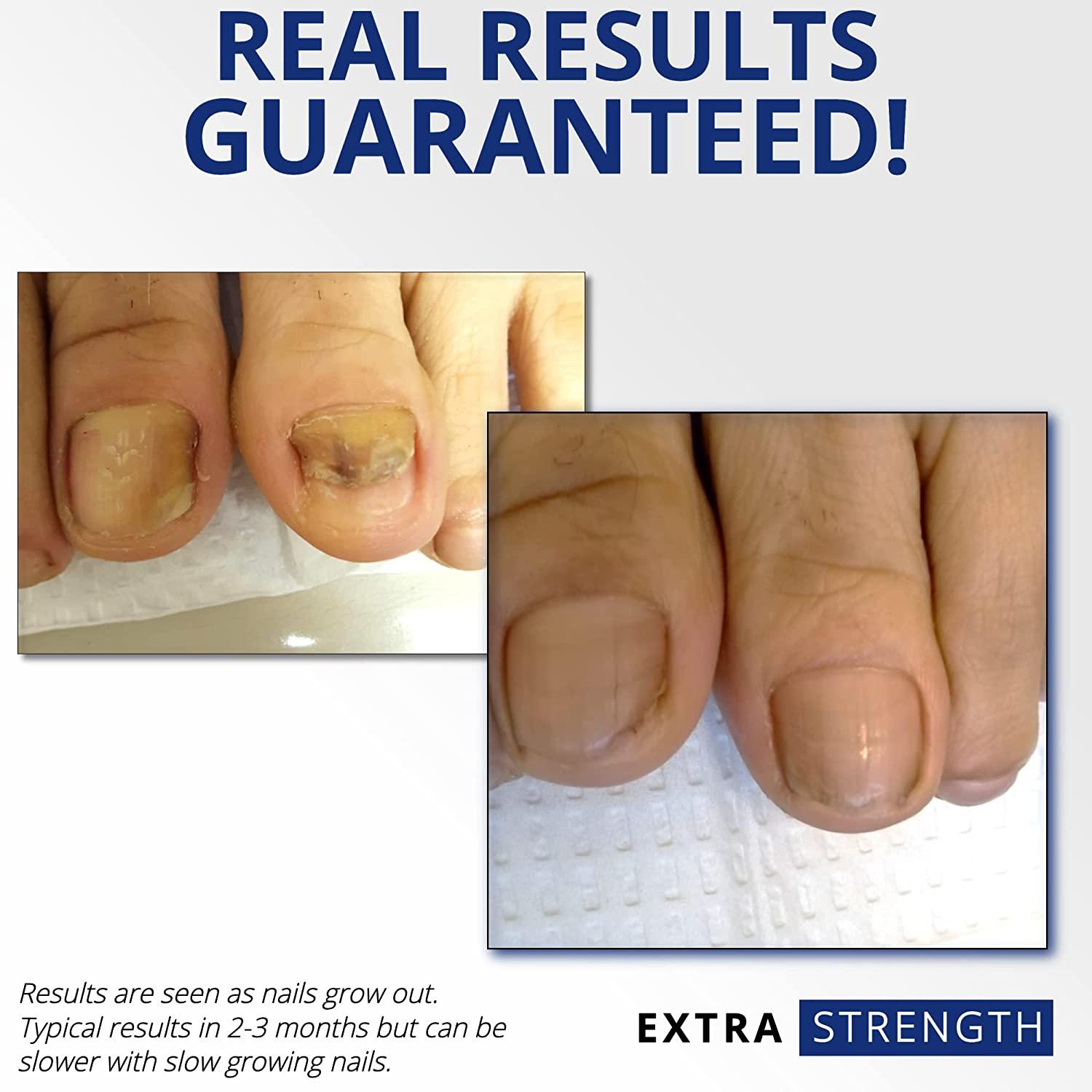 ClearNail Pro+ Extra Strength Toenail Fungus Remover Restore