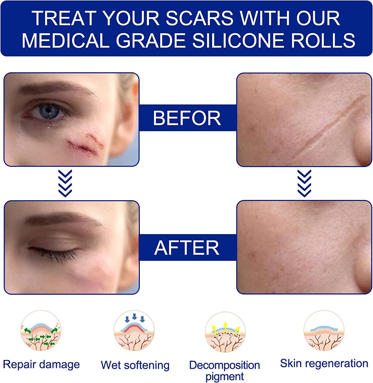 Silicone Scar Sheets, Silicone Scar Tape Roll 1.6”x 60”(46 Month Supply), Soft Silicone Gel