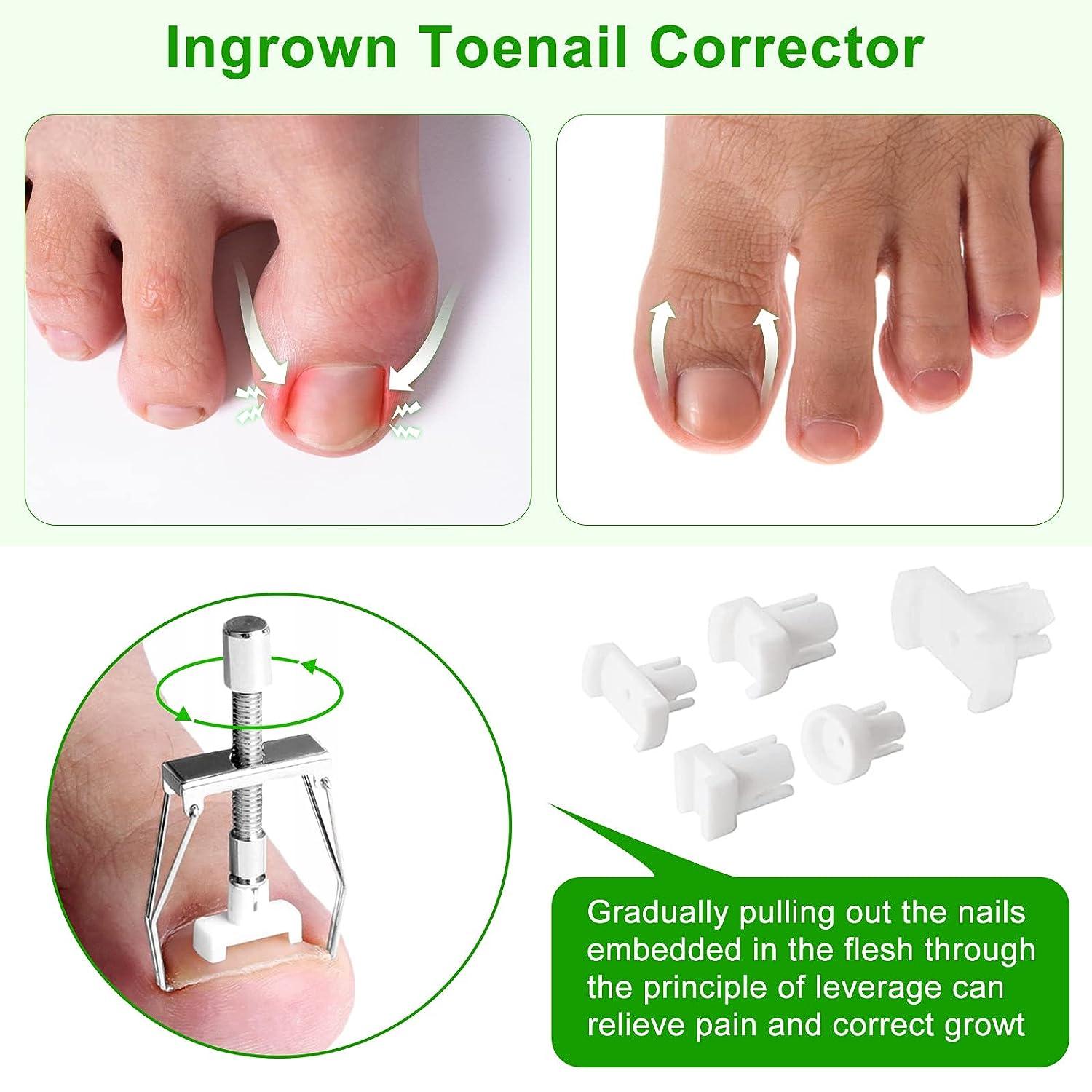 Ingrown Toenail Removal Kit 11 Pcs Ingrown Toenail Pain Treatment