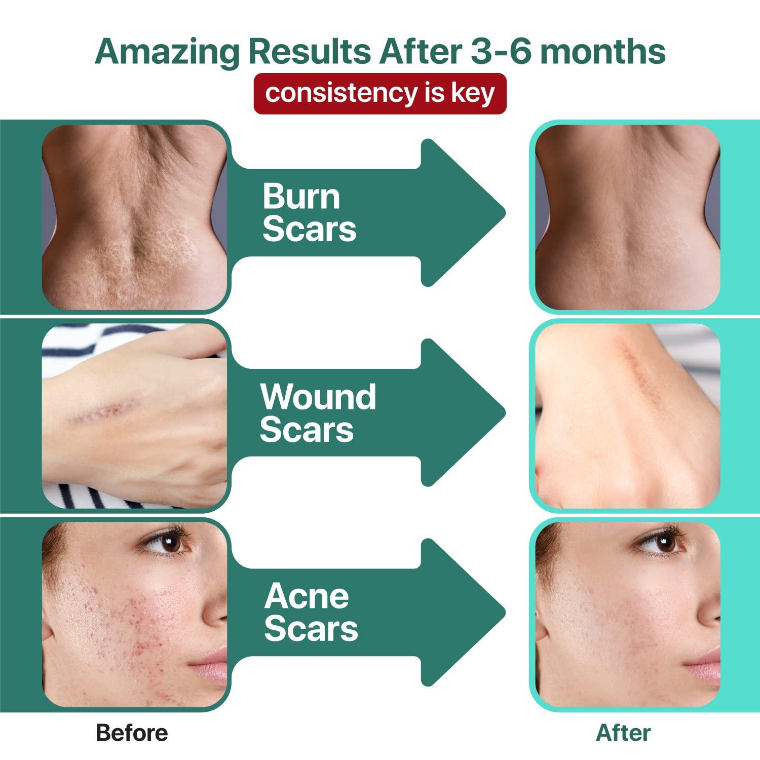 Vitamin e for acne scars cheap