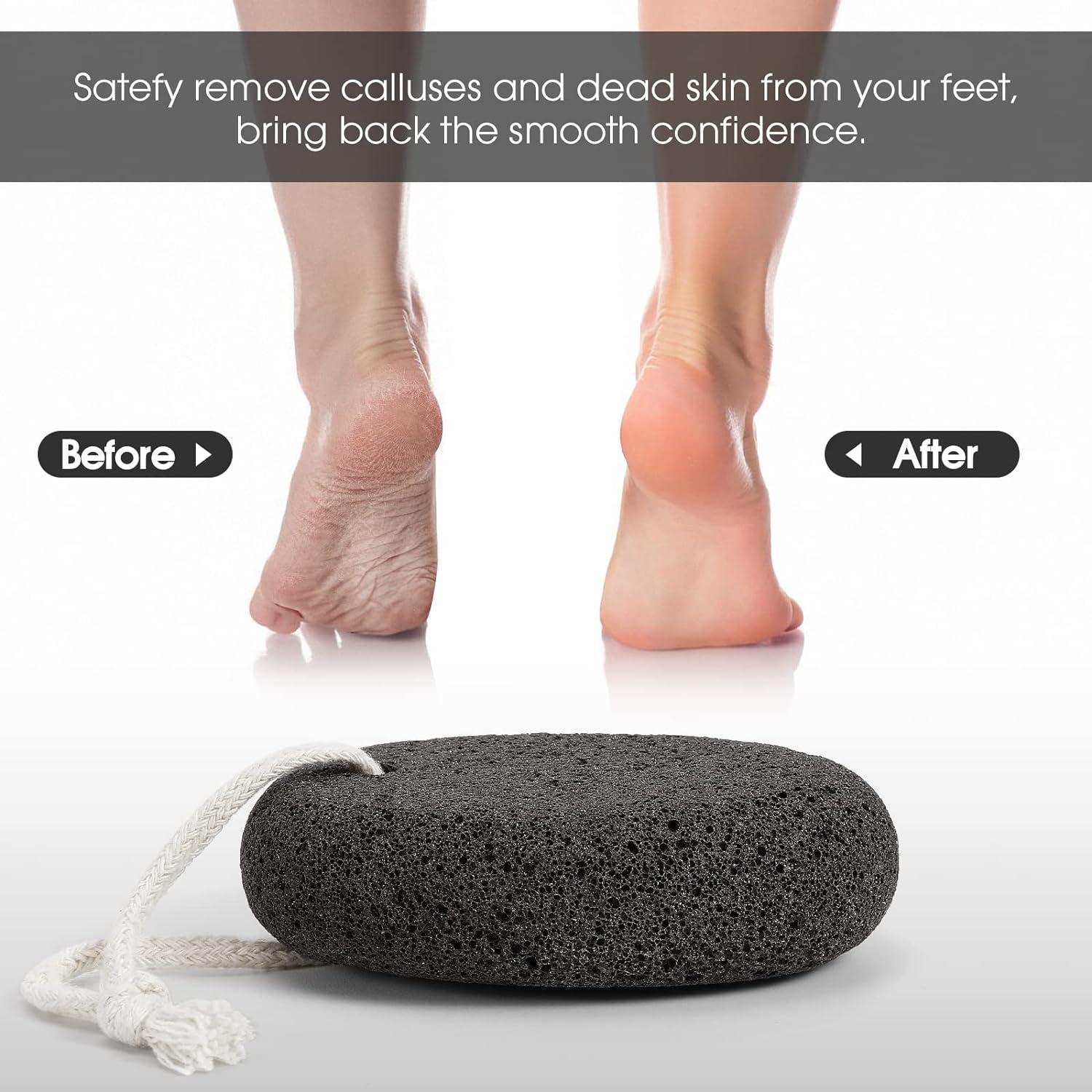 Pumice Stone for Feet 2 Pack Natural Foot Scrubber Pummis Pumas Stones for  Hard Skin Callus Remover Foot File Exfoliation Pedicure Tools Lava Pumice  Rock for Heels Hands to Remove Dry Dead