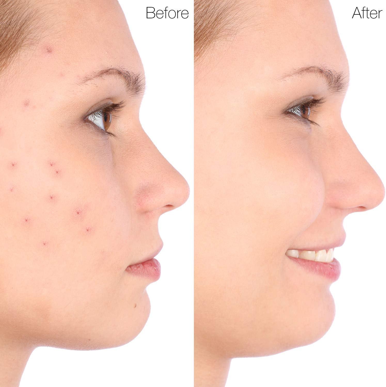 Marquee 5Piece Acne Blackhead Removal Tool Set Skin Care Essentials