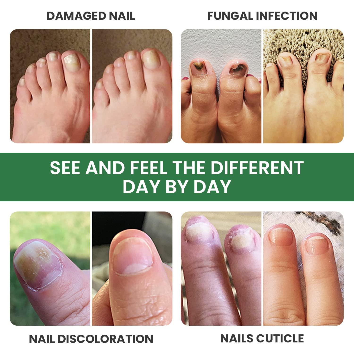 MedFeet - Toenail trauma can result in secondary bacterial or fungal  infection if any part of the nail has come loose. �� This can lead to the  dark discoloration of the toenail.