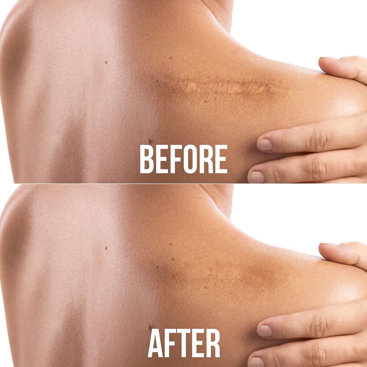 JJ CARE Silicone Scar Gel 1.4 Oz. (40g) Medical Grade Scar Removal Gel