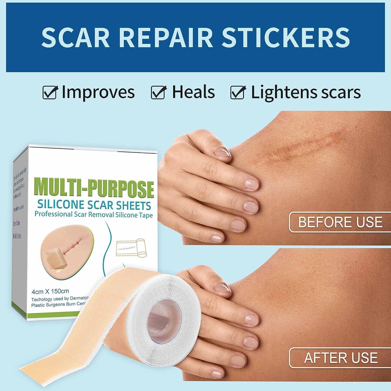 Silicone Scar Sheets (1.6 x 60 ) Scar Reducing Silicone Scar Sheets