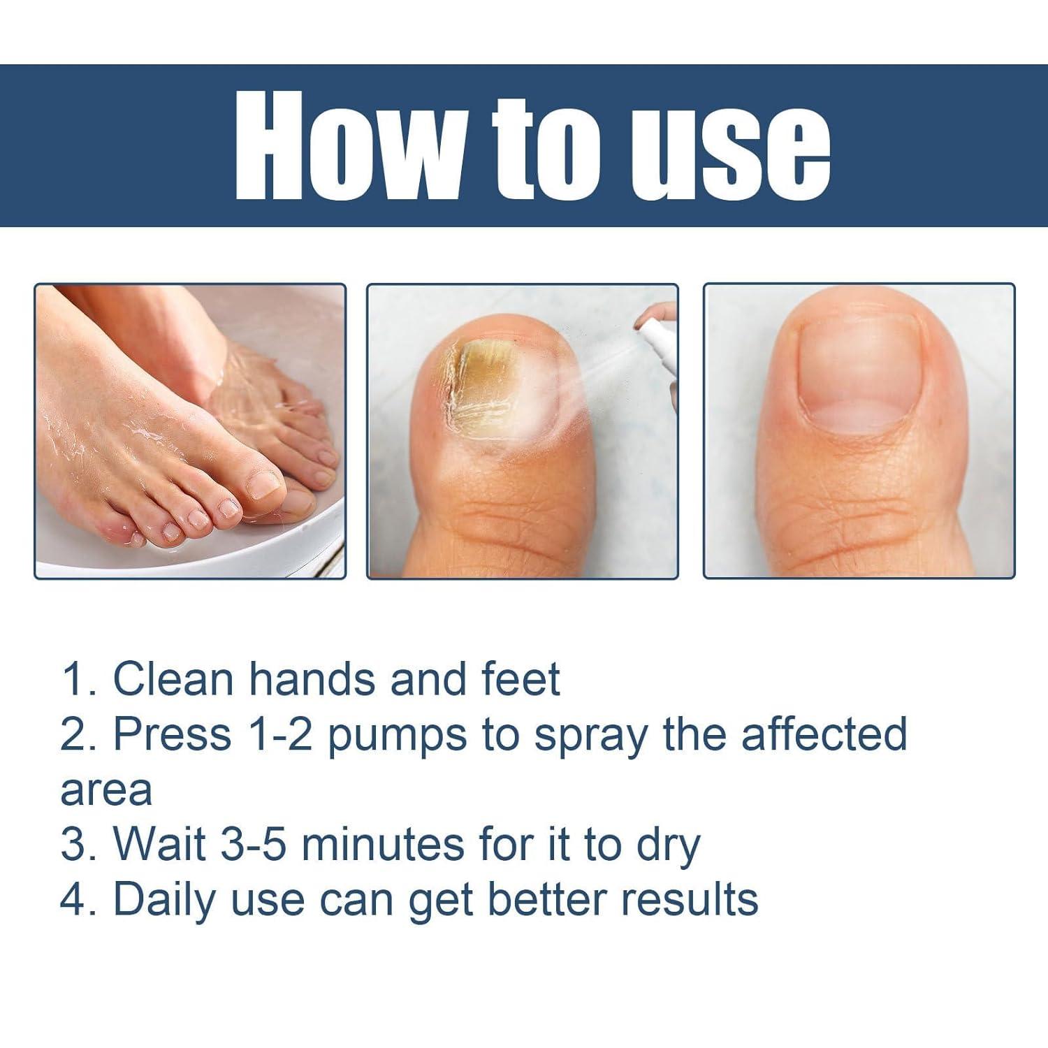 3 Pcs Furzero Athletes Foot & Nail Treatment Spray Medical Grade Anti