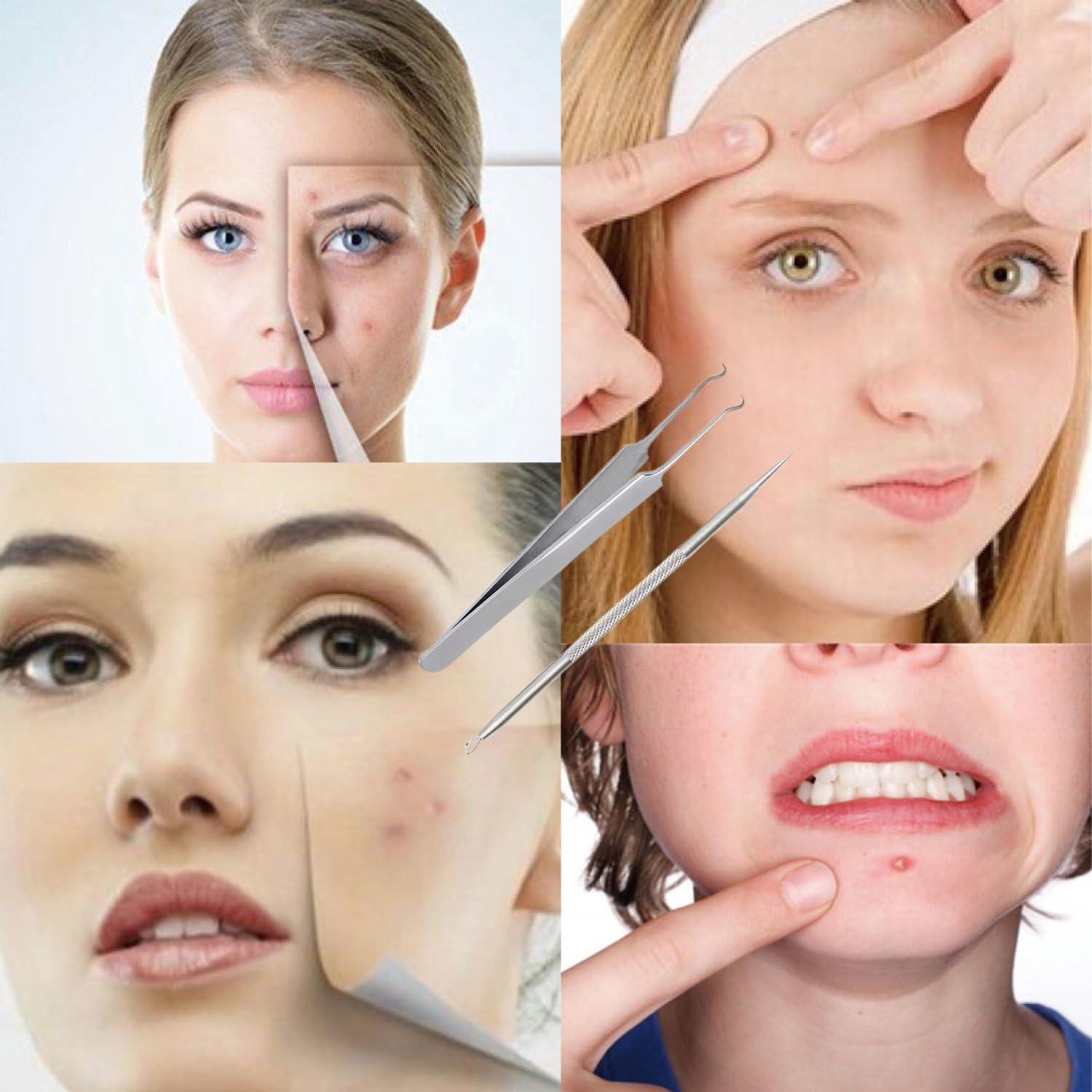 FIXBODY Stainless Steel Blackhead and Splinter Remover Tools Kit ...