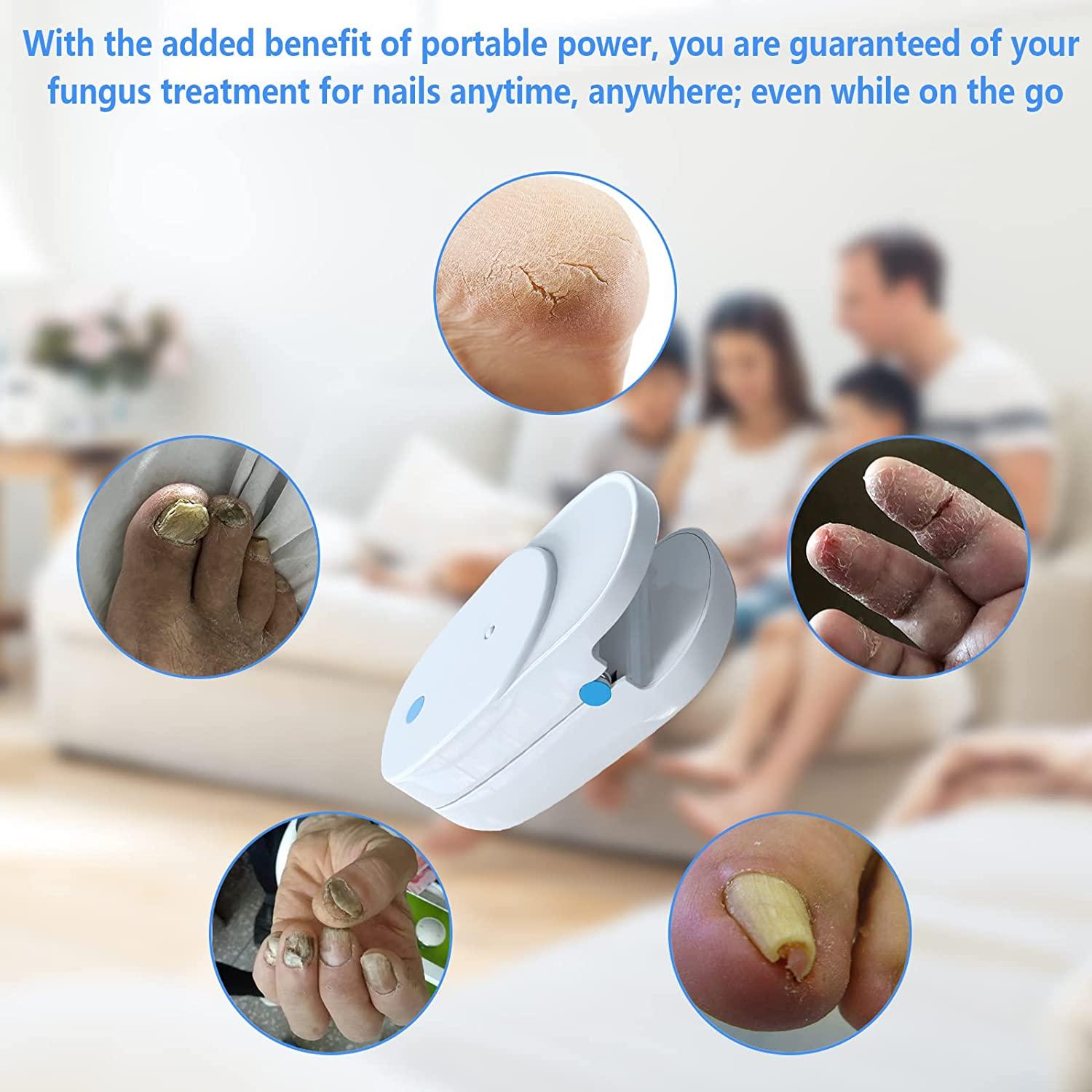 Nail Fungus Cleaning Laser Device Revolutionary Home Treatment for