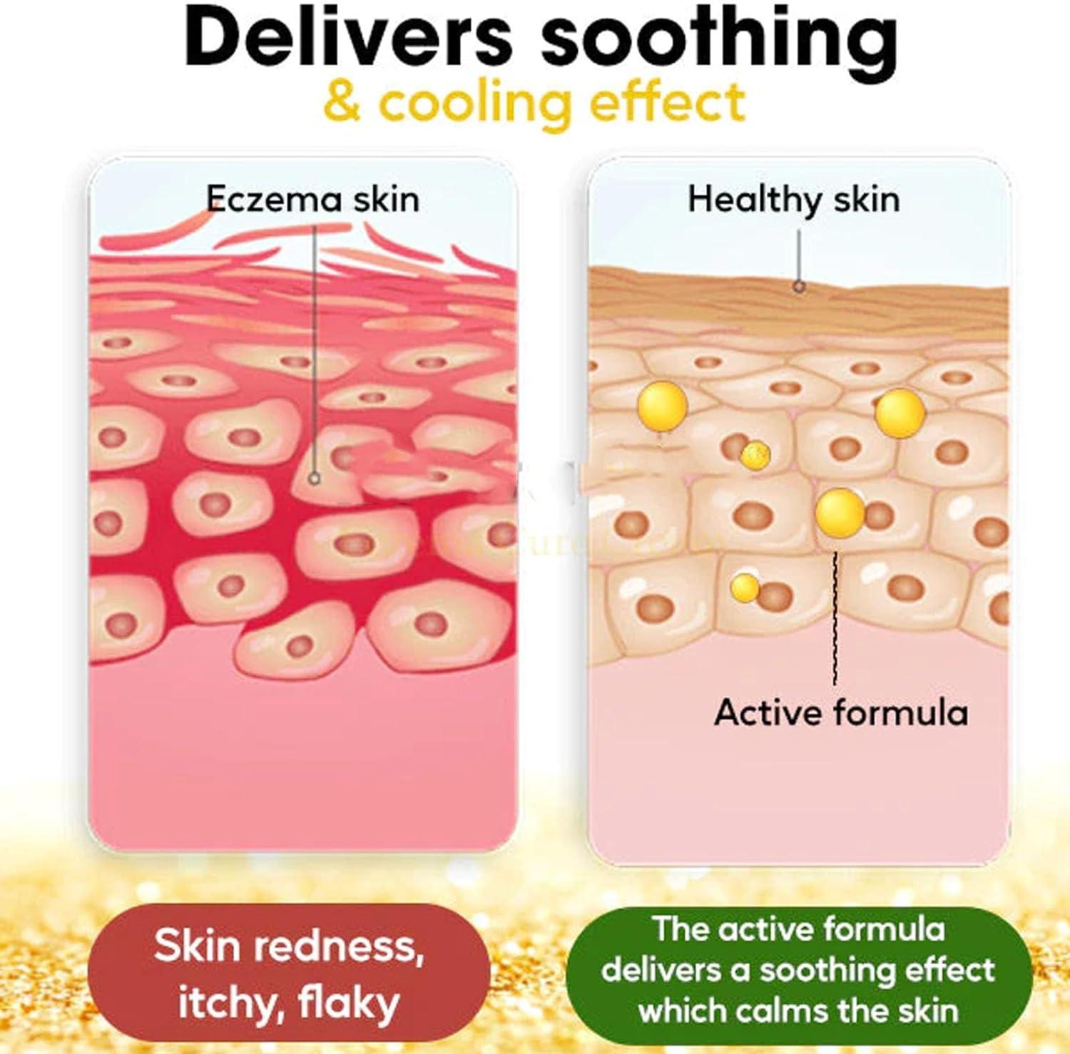 Eczema and Psoriasis Relief Cream Set Soothes Irritated Skin, Treats