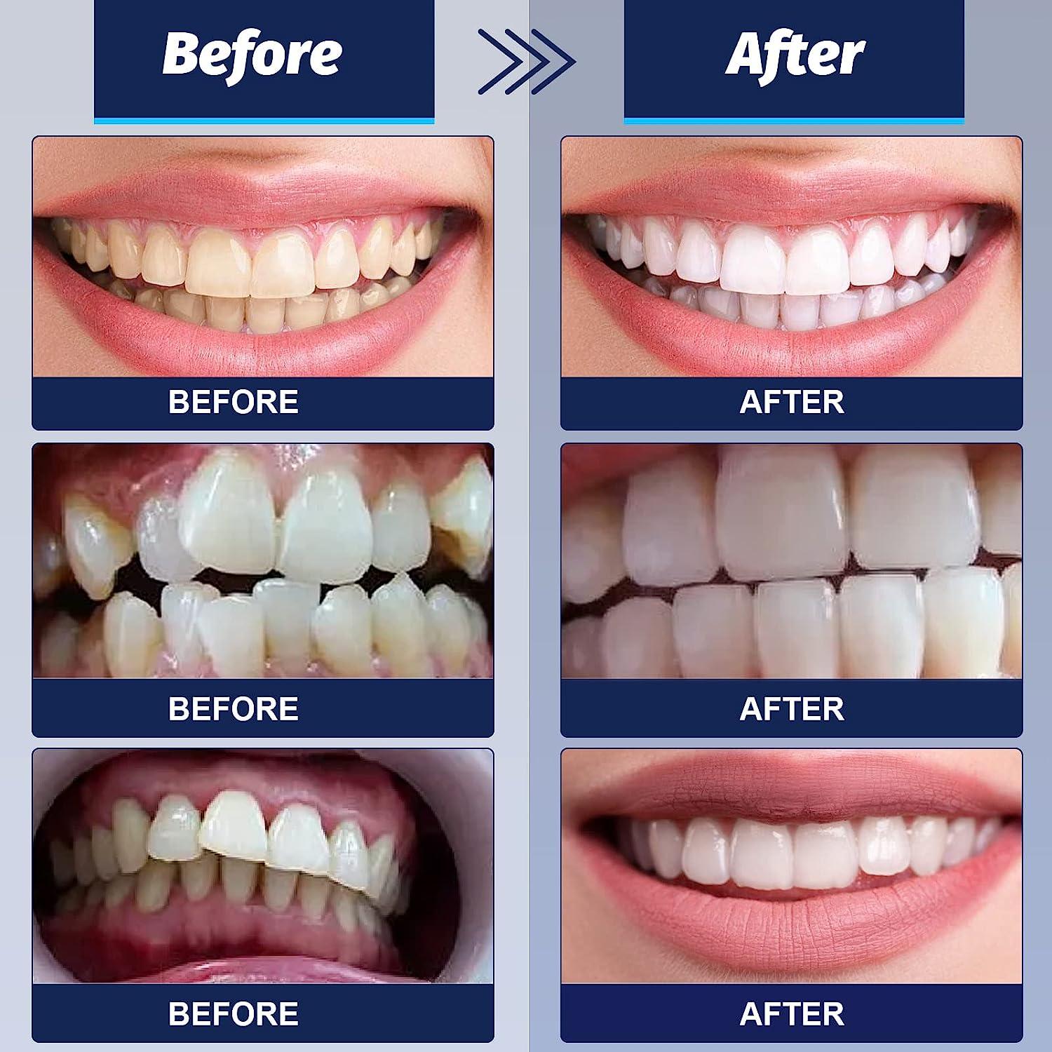 DIY Tooth Repair Kit With Moldable Beads - Fix Chipped & Broken Teeth At Home