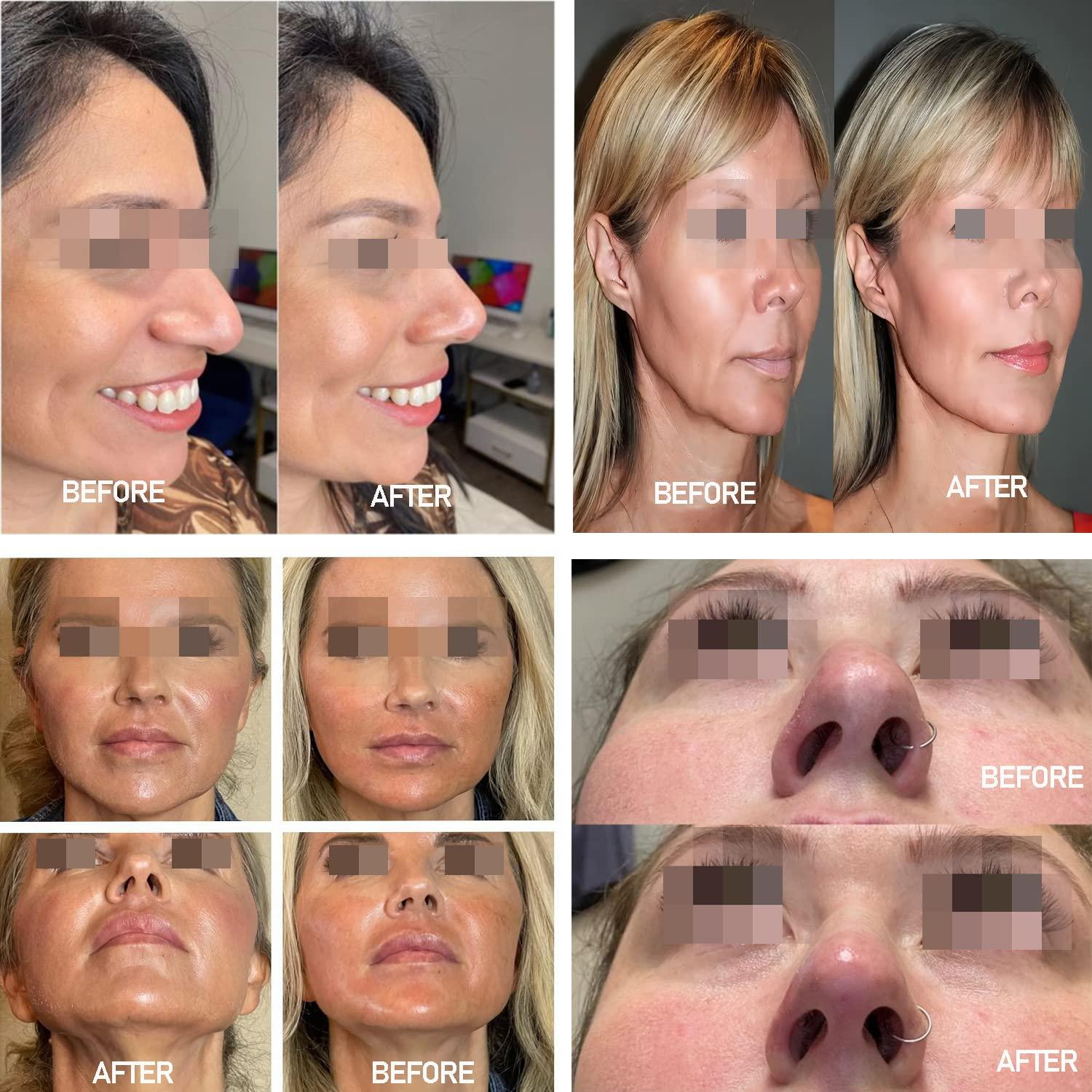 Elves PDO Nose Thread Lift/Nasal 4d COG Pdo Threads for Nose 19G60mm