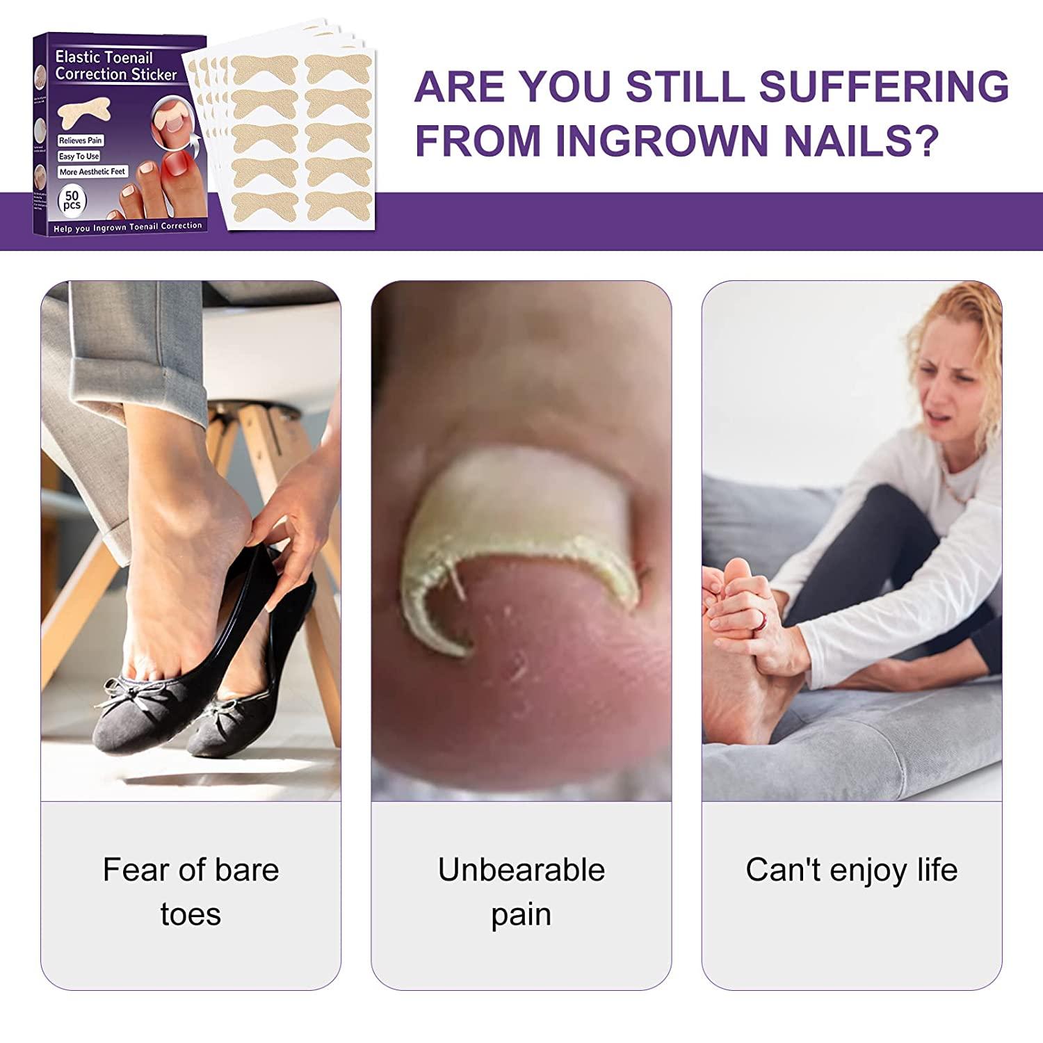 IngrownToenailTreatment IngrownToenailPainRelief IngrownToenailToolforEasyTrimming