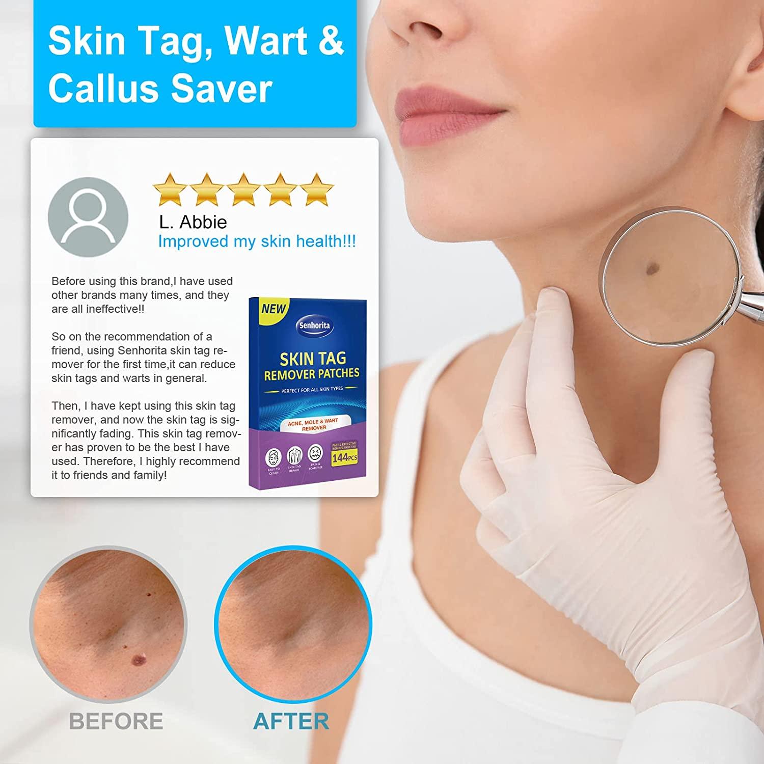 Is Vora Skin Tag Remover Legit Skin Tag Remover Patches - 144Pcs | Safe & Painless Wart Removal for