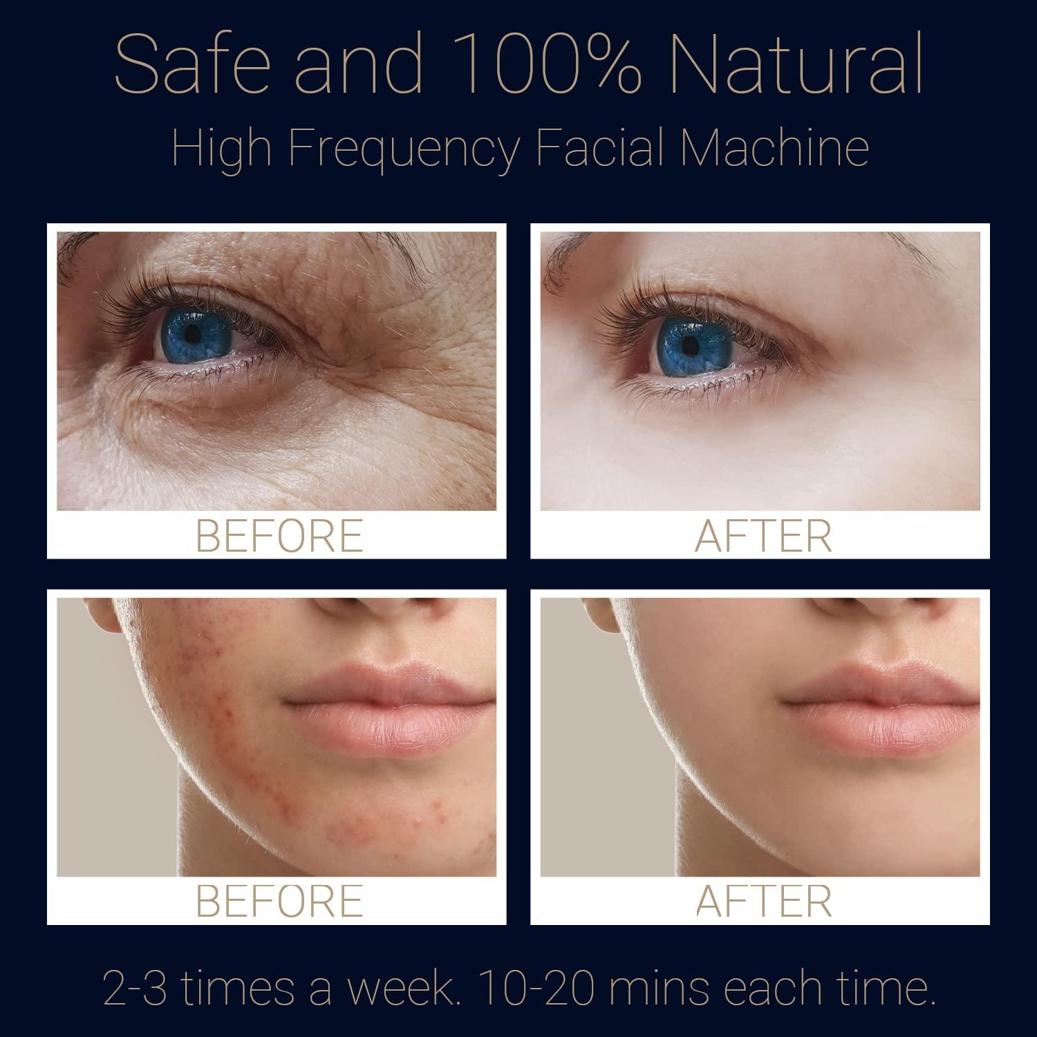 UUPAS 6 in 1 Portable High Frequency Facial Wand with 6 Blue Glass