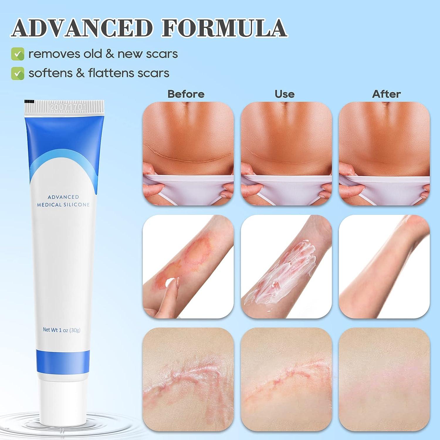 Silicone Scar Gel Physician Formulated Treatment Cream for Keloids, C