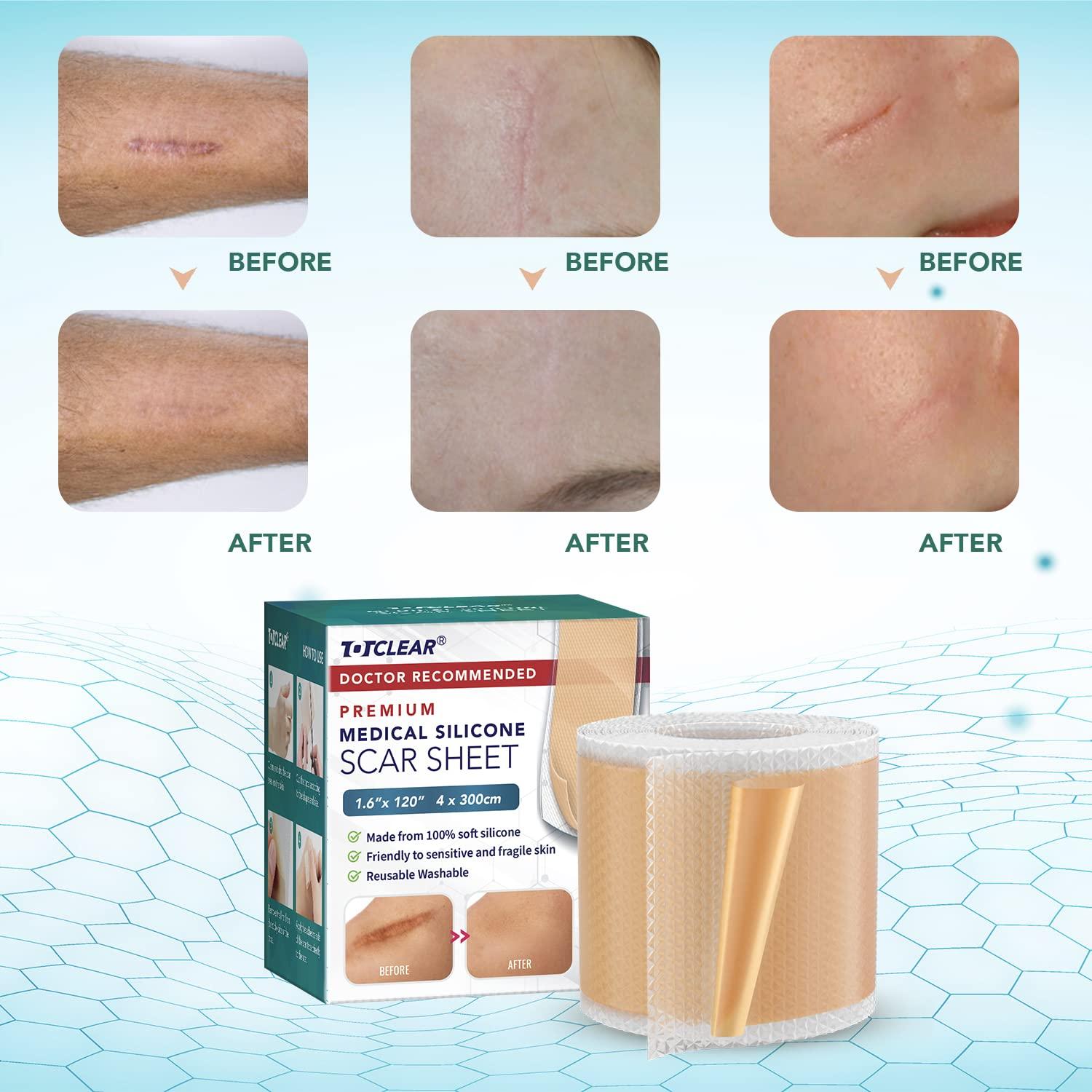 Totclear Silicone Scar Sheets (1.6x12 Roll) Painlessly Remove Surgery