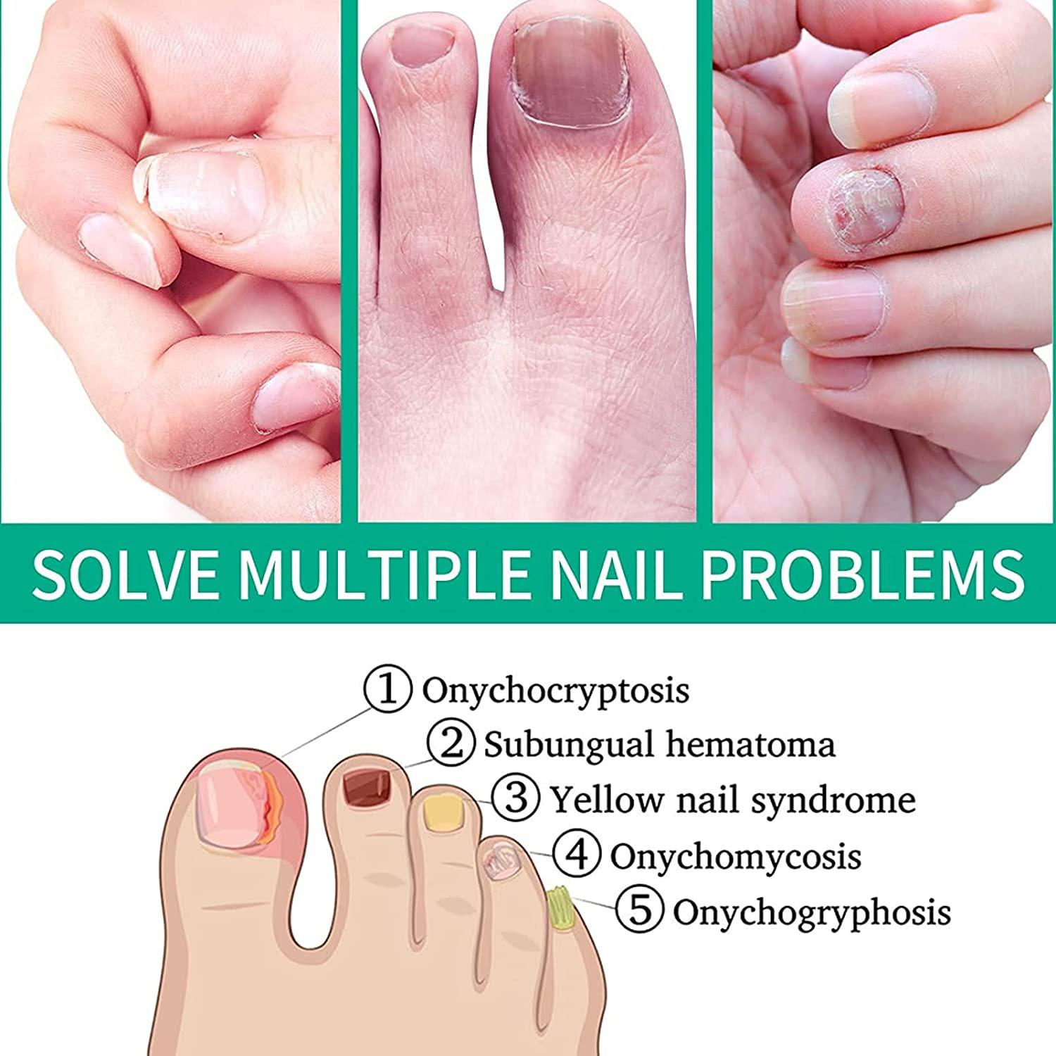 Ouhoe Kerassentials Nail Fungus Repair Liquid 1 Oz FastActing Formula
