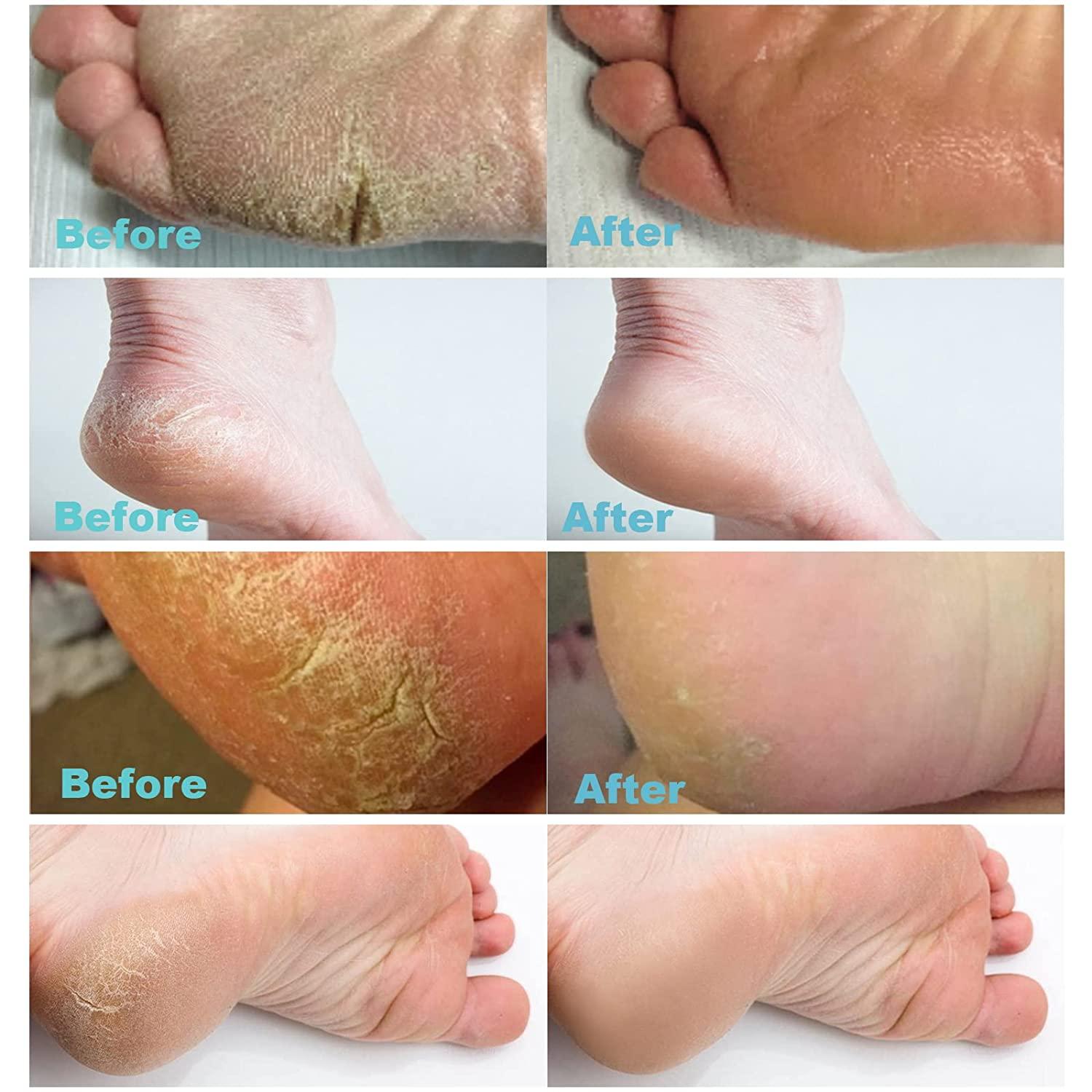 118ml) - Urea Cream 42% Plus Salicylic Acid 118ml, Upgraded Callus Remover  Hand Cream Foot Cream for Dry Cracked Feet, Hands, Heels, Elbows, Knees,  Intensive Moisturises & Softens Skin, Exfoliates... : Amazon.ae