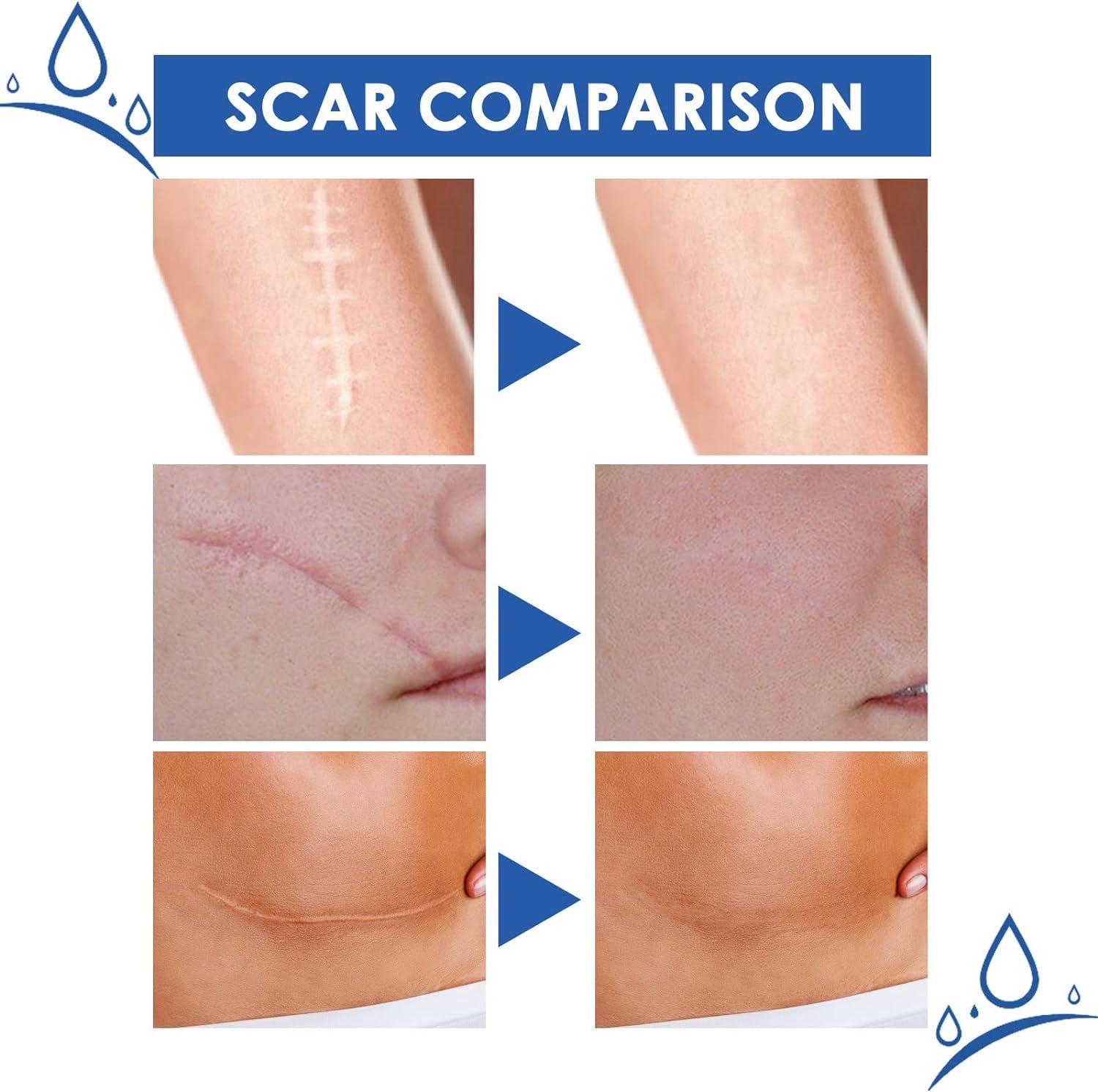 Gentle Scar Removal Scar Repairing Diminishing Skin Scar Scar for All Skin  Types (as Shown One Size) As Shown One Size