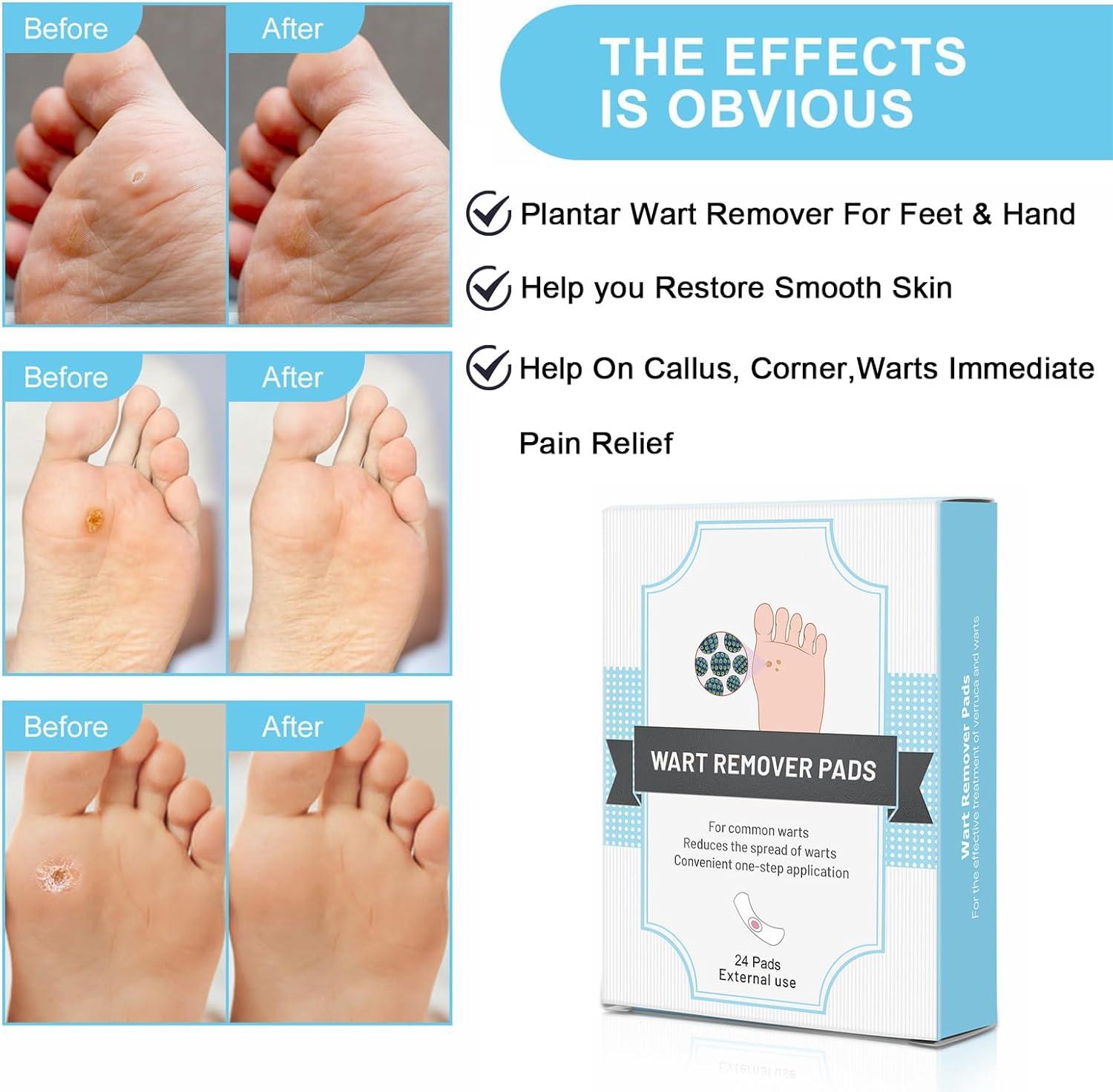 Wart Remover Wart Remover for Hands Corn Remover for Feet Corn Removal