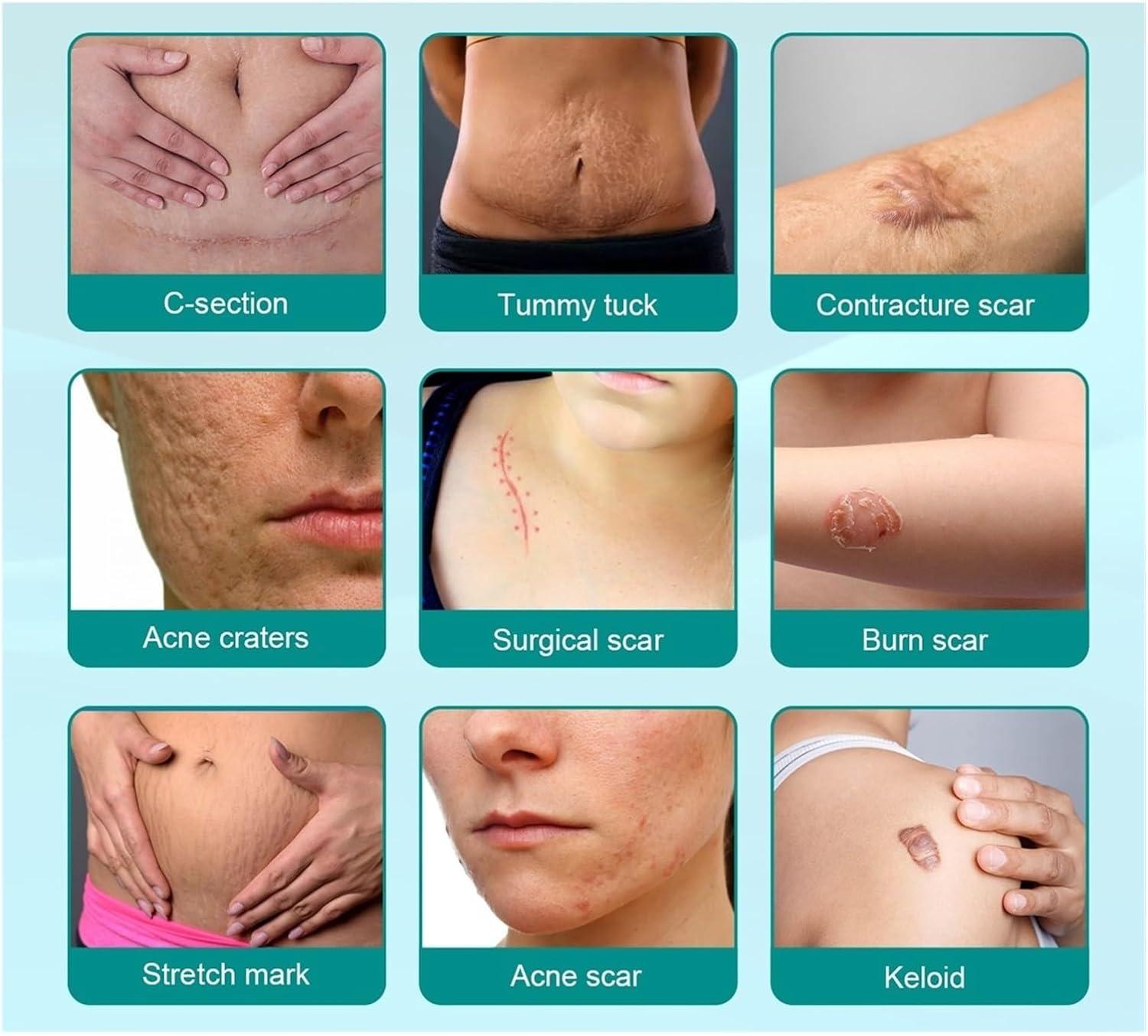 NETFEN Scar Remove Advanced Medical Grade Spray 3 Bottles Effective