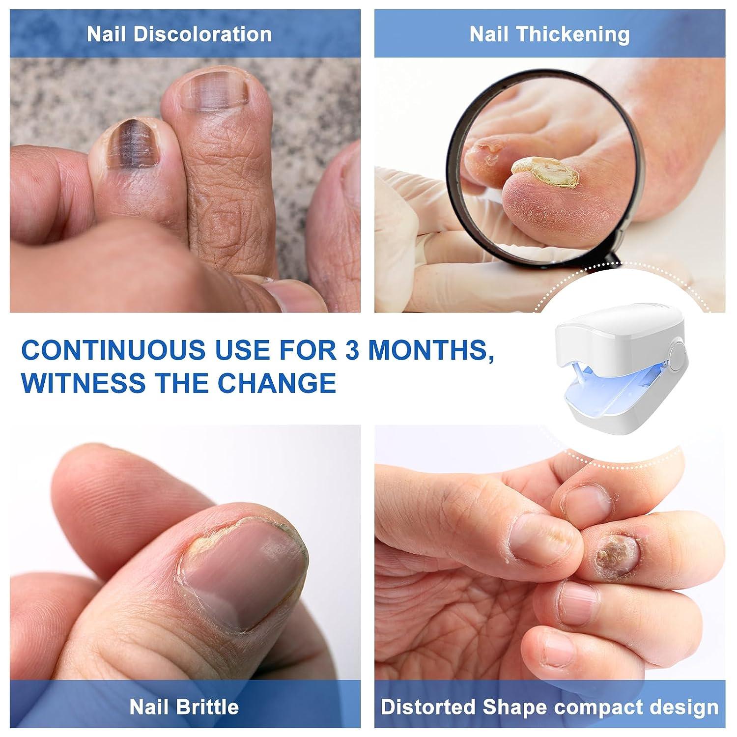 Nail Fungus Treatment Kit for Toenail Fungus Treatment Onychomycosis