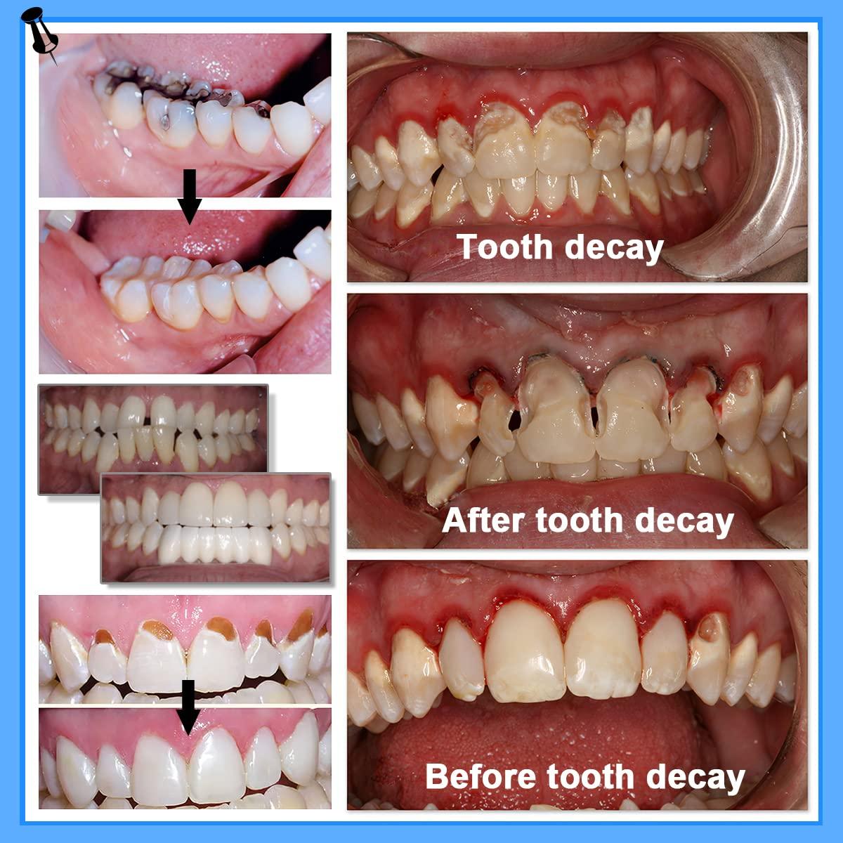 Tooth Repair Kit Includes 3 Moldable Denture Option That Can Option