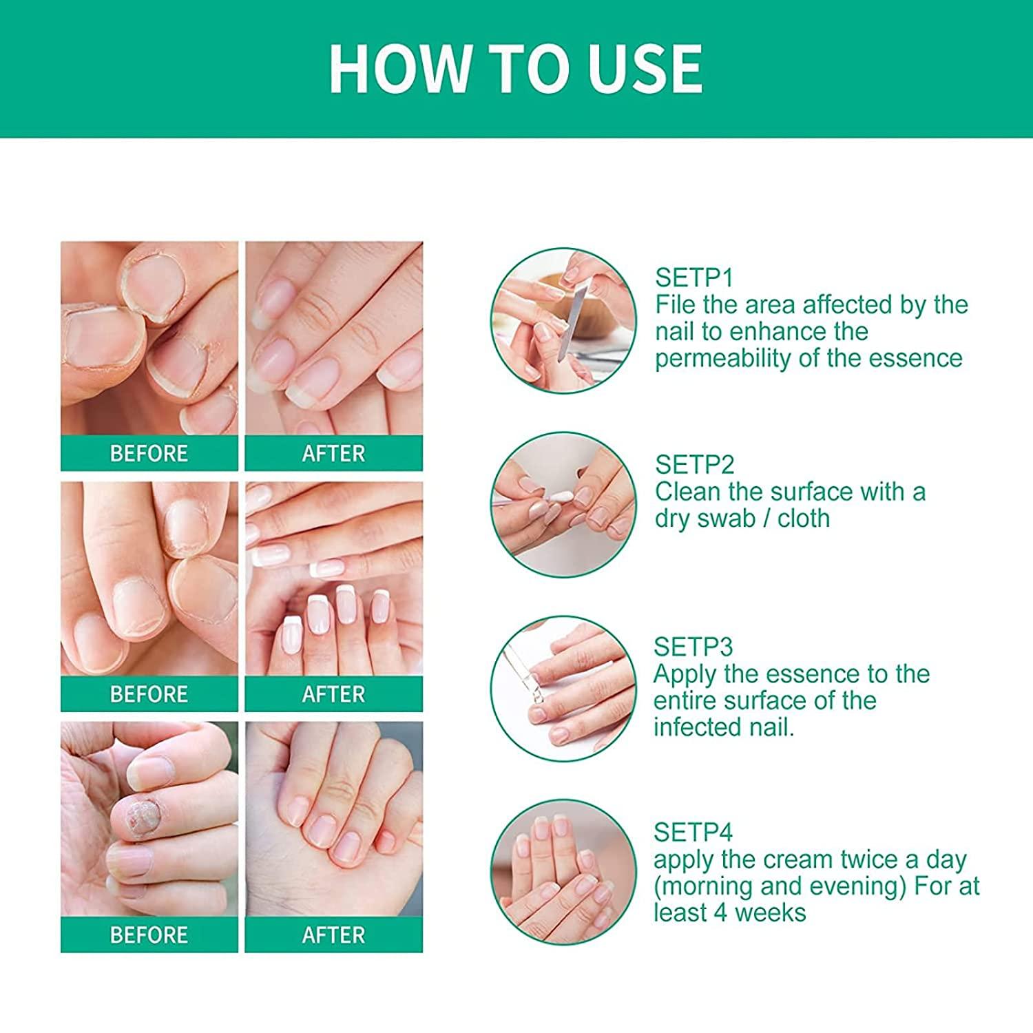 Ouhoe Kerassentials Nail Fungus Repair Liquid 1 Oz FastActing Formula