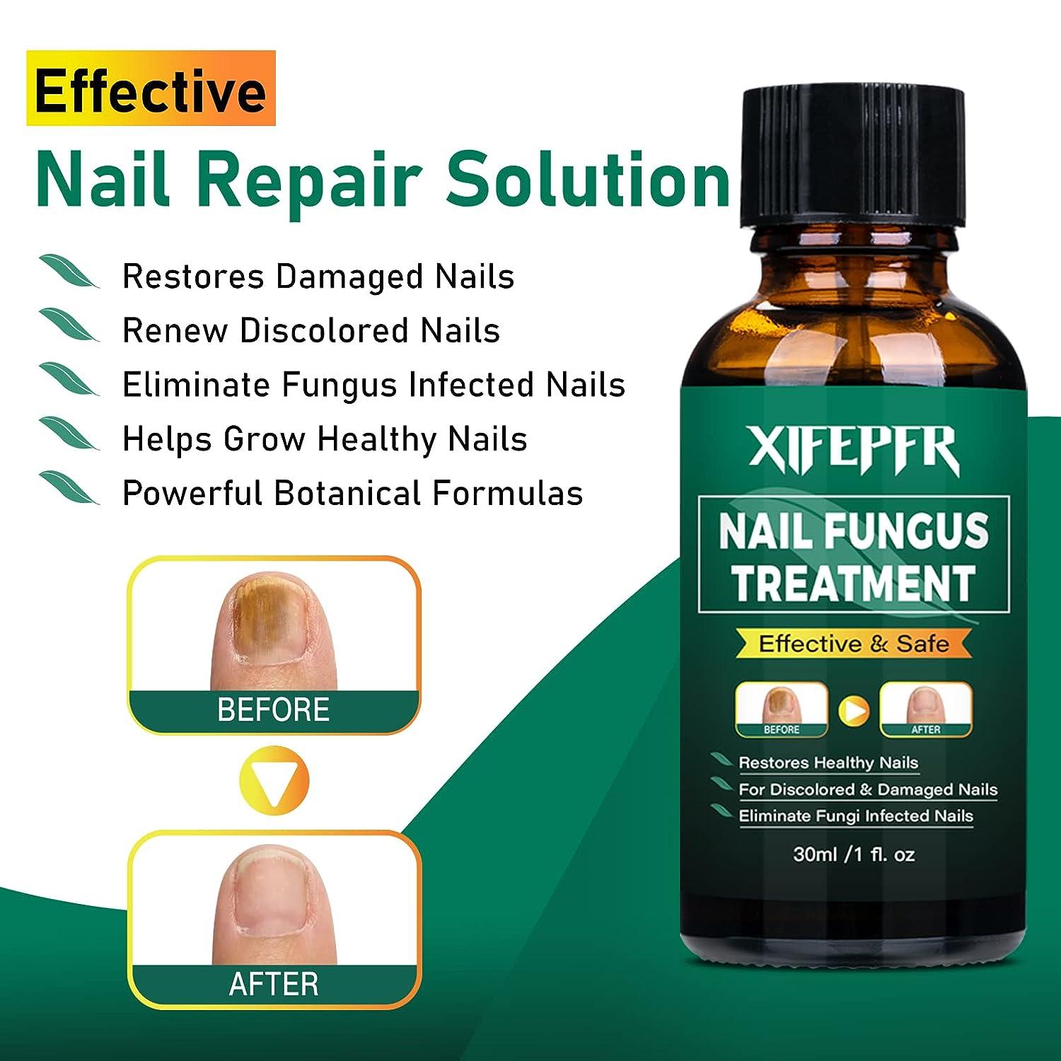 XIFEPFR Toenail Repair Treatment Extra Strength, Nail Repair Solution