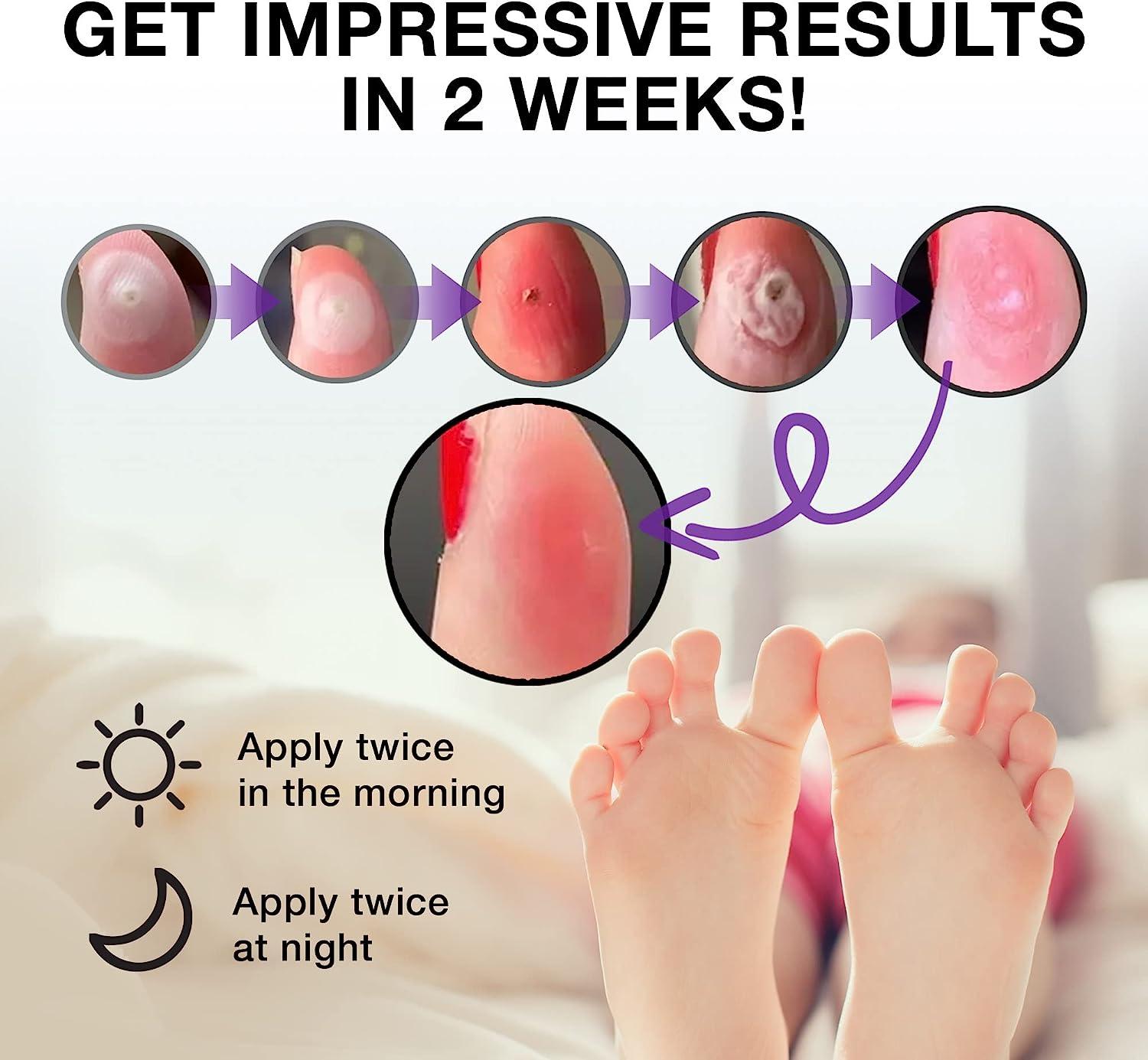 Pureskin Extra Strength Liquid Corn Remover for Toes and Feet