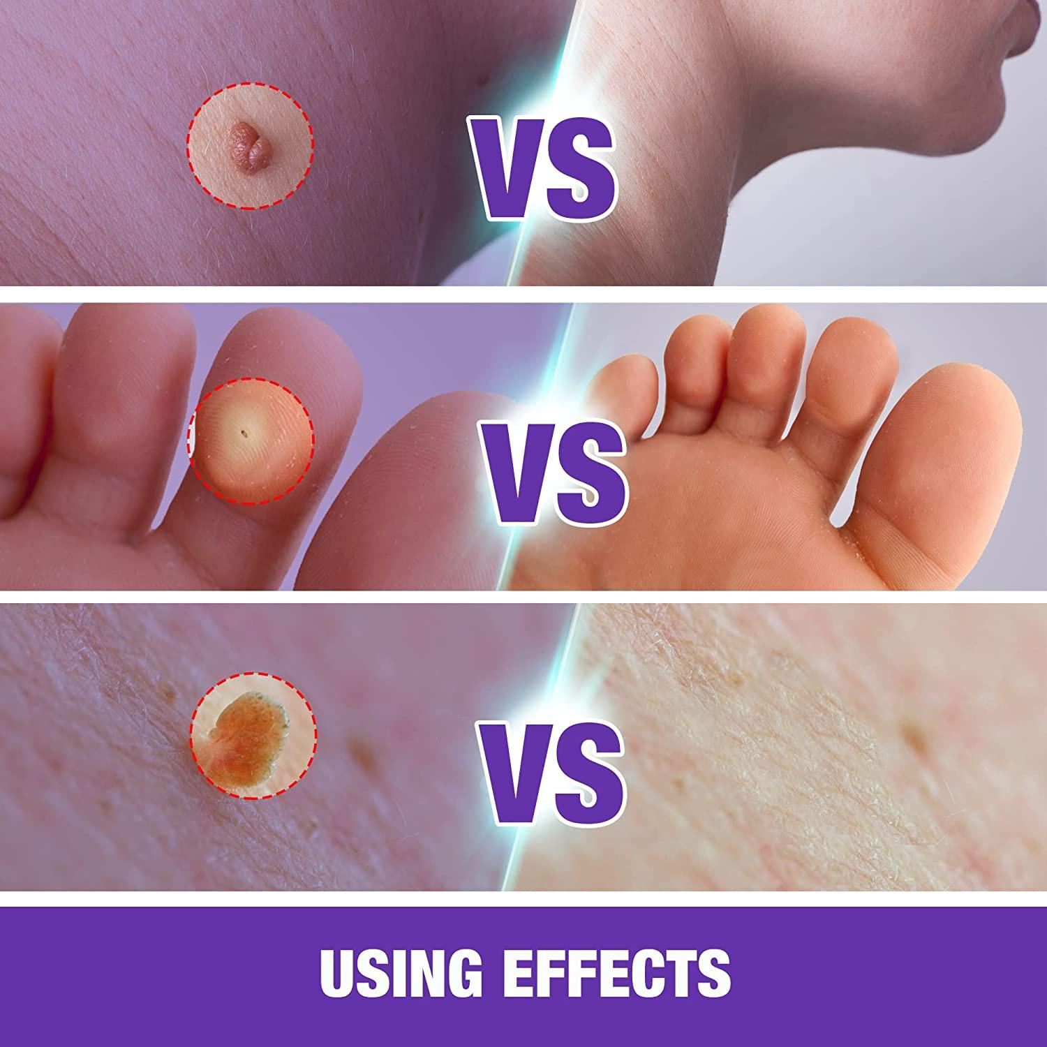 Liquid Skin Tag Remover Patches Extra Strength*2, Liquid Skin Tag