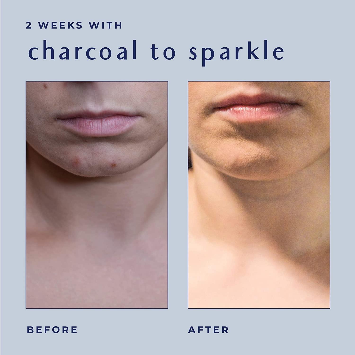 Ayadara Cystic Hormonal Acne Charcoal Face Wash Deep Cleansing Sulfur