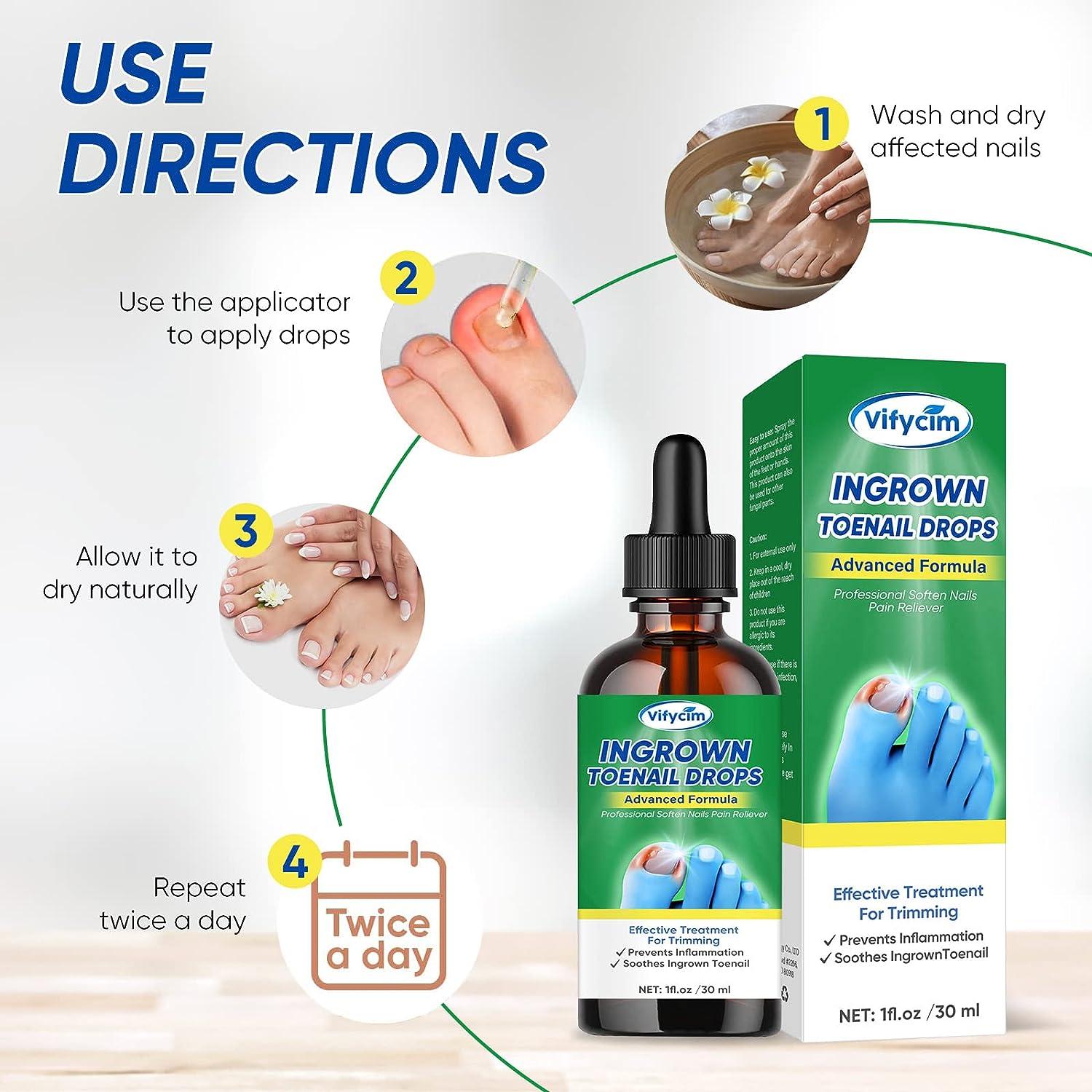 Ingrown Toenail Treatment Ingrown Toenail Corrector Drops Professional