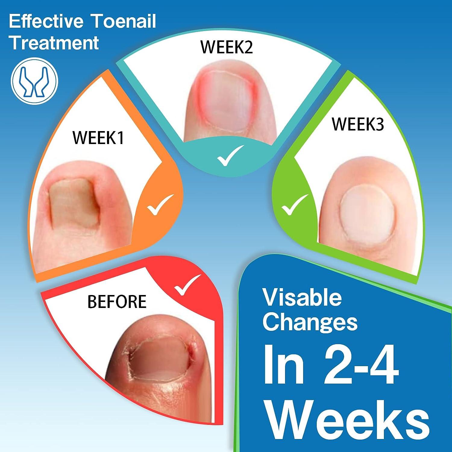 Ingrown Toenail Treatment Kit 41 Pcs/Set with Professional Tools for