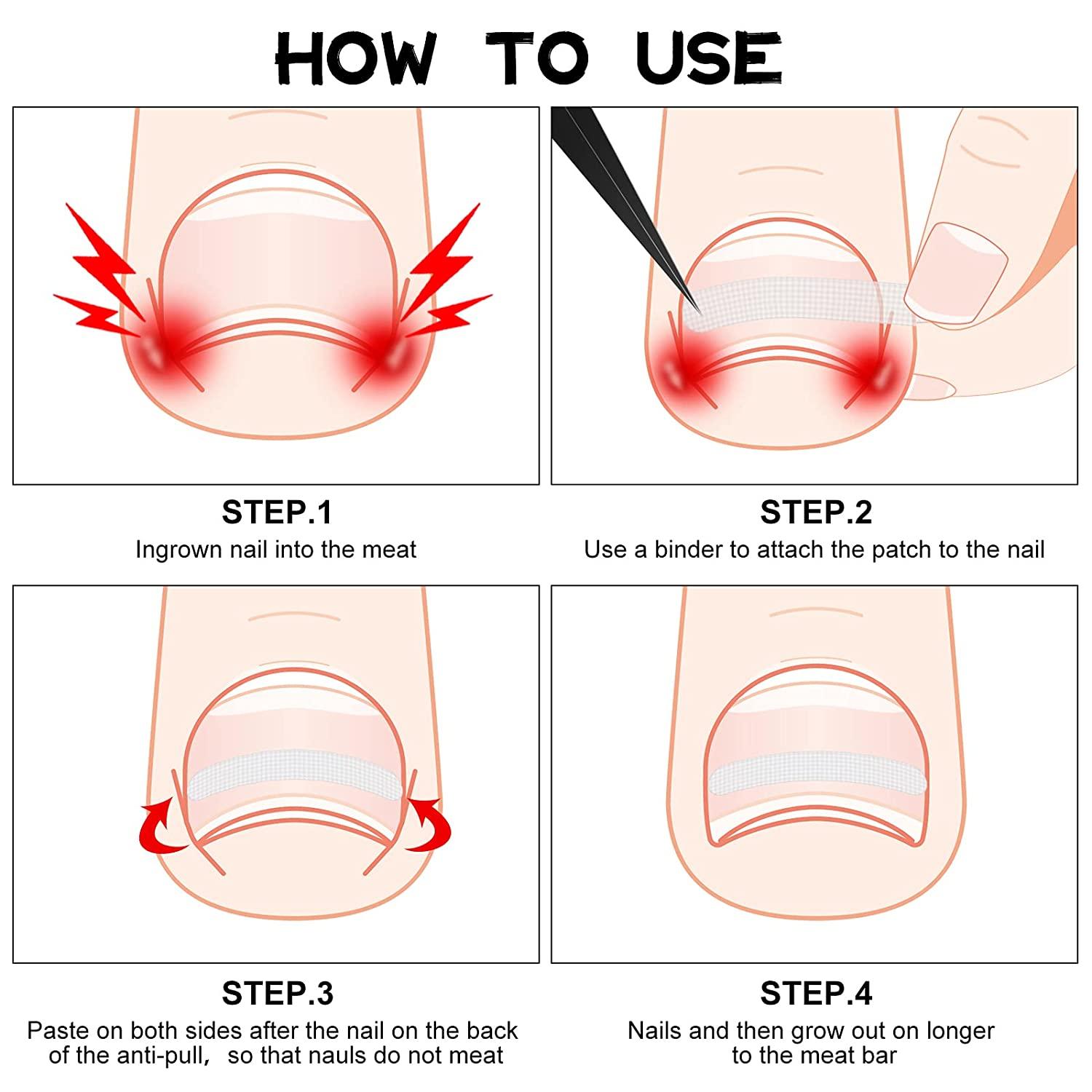 Ingrown Toenail Corrector Strips 60 Pieces Toe Nail Correction