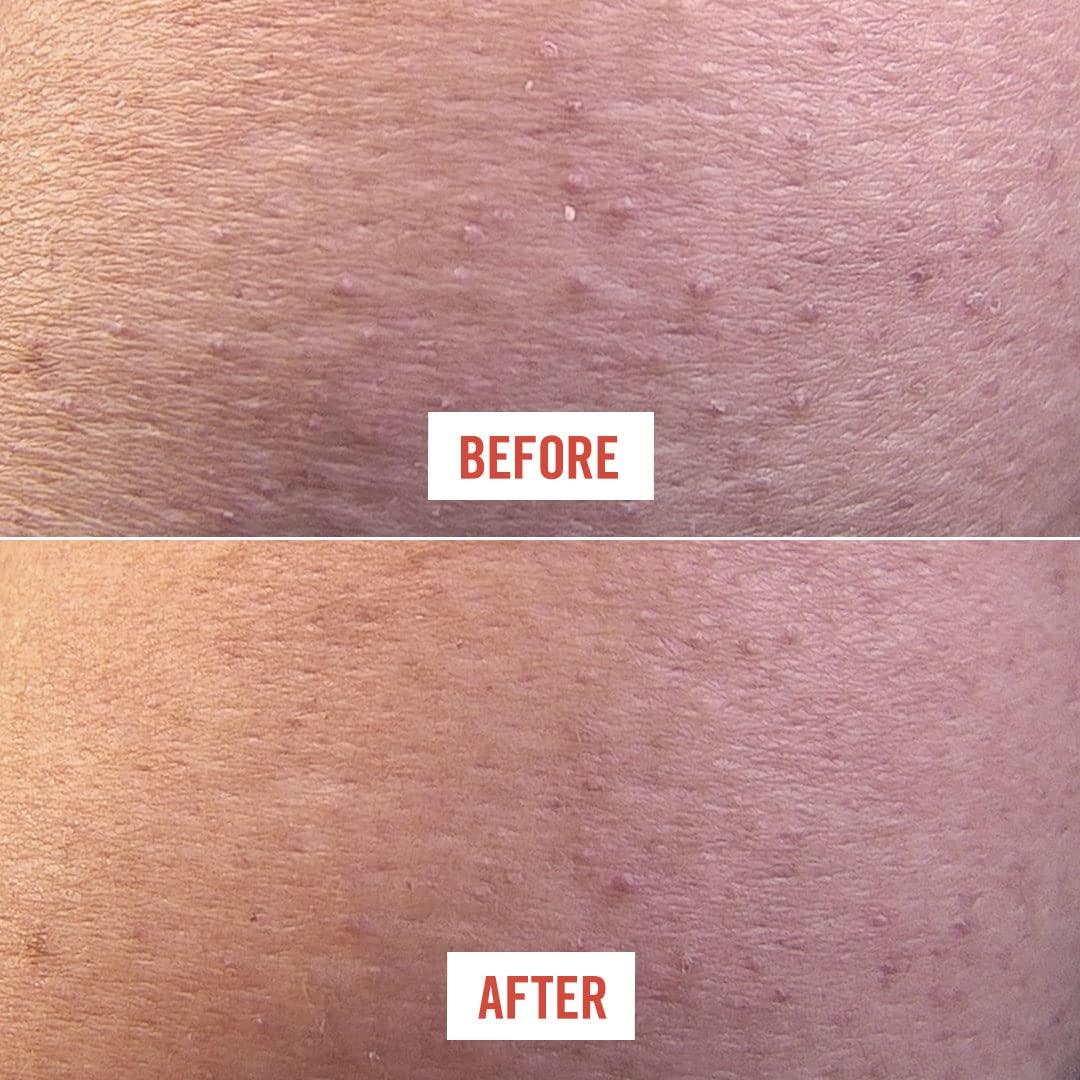 First Aid Beauty KP Bump Eraser Body Scrub Exfoliant for Keratosis