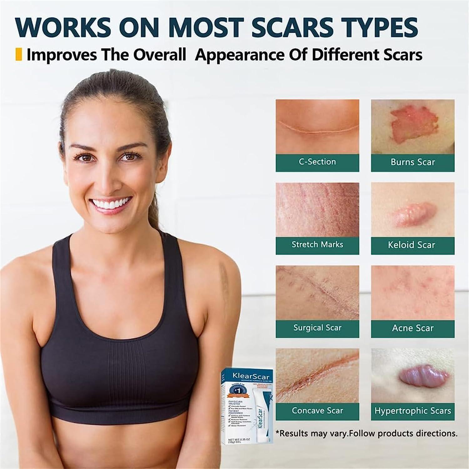 Klearscar Advanced Scar Removal Gel Scarremove Medical Grade Scar