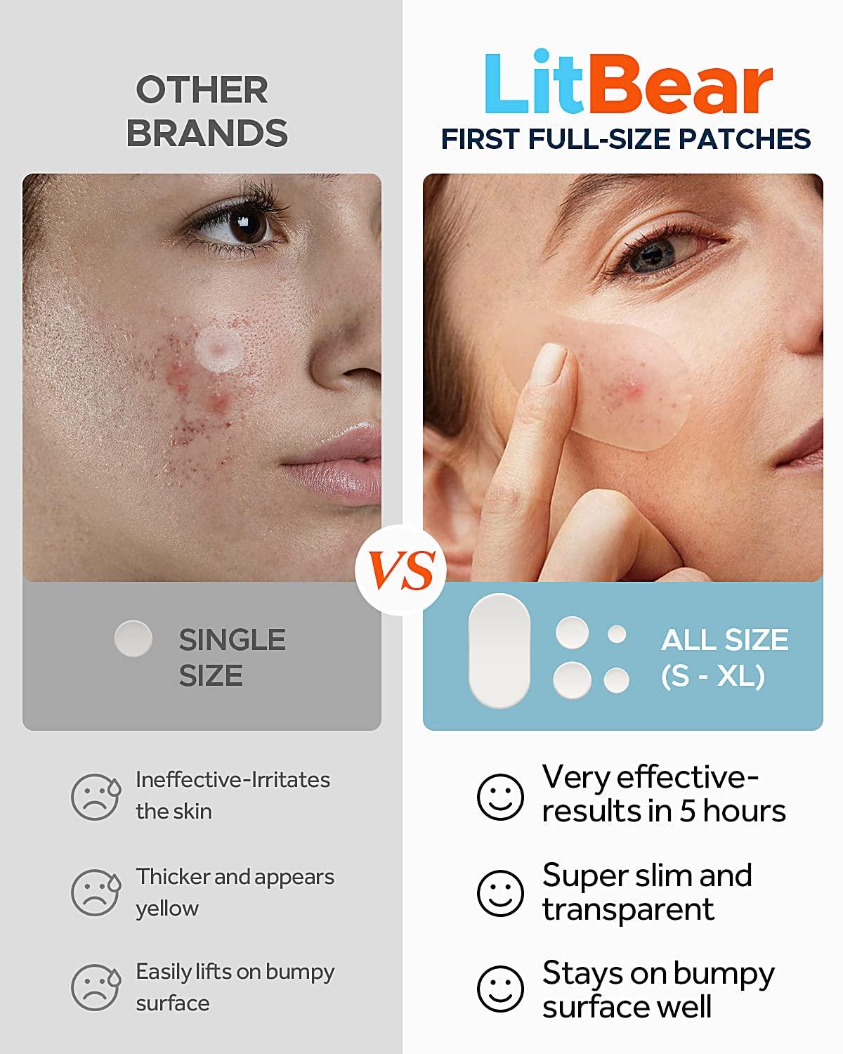 Acne Pimple Patches, 5 Sizes 80 Patches for Large Zit Breakouts, LitBear Acne Patches for Face