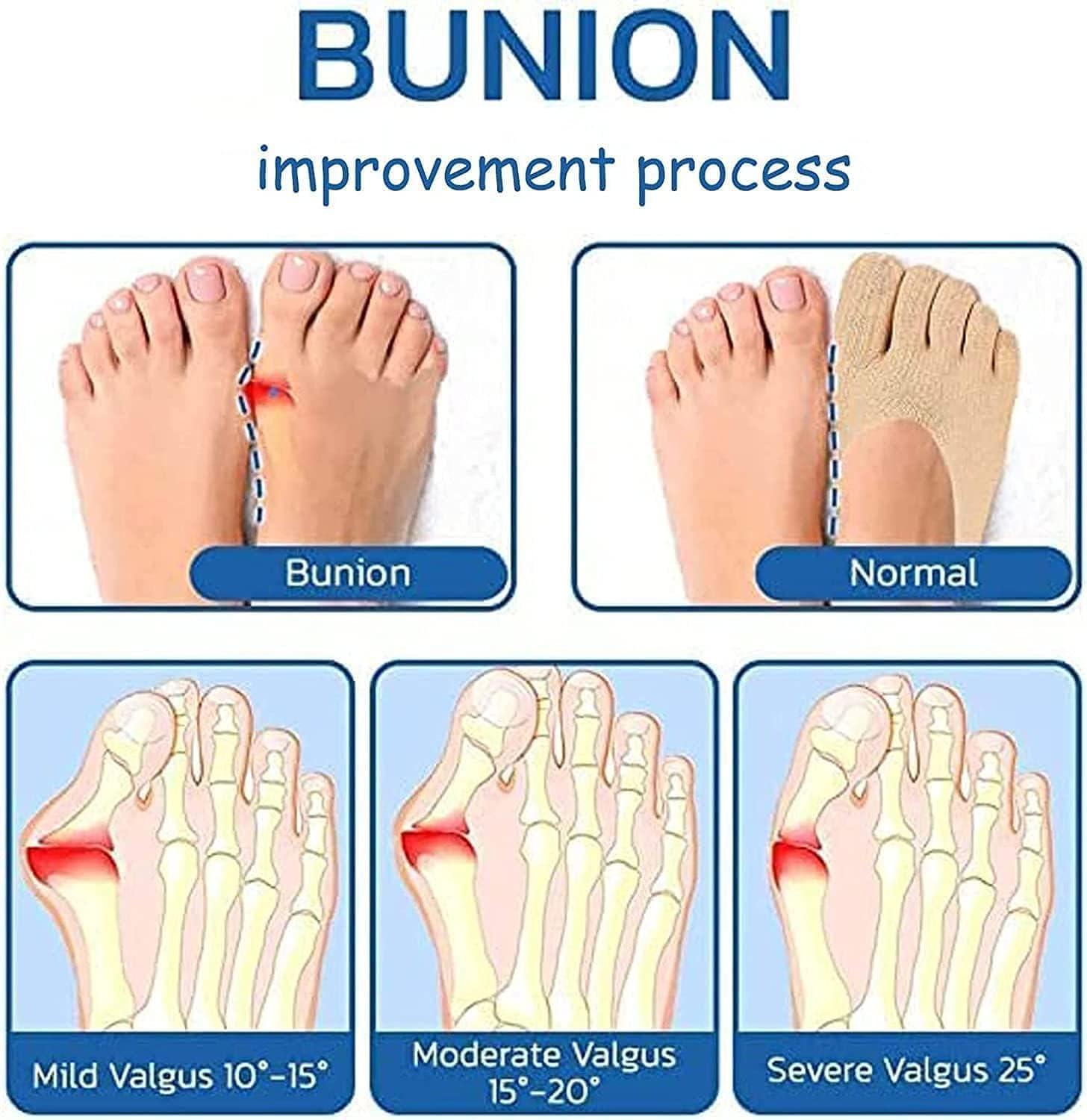LSNTUU Orthoes Bunion Relief Socks for Women Orthopedic Toe Compression
