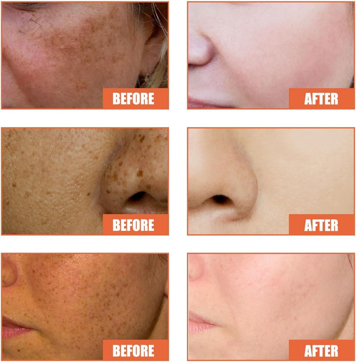 glutathione cream before and after N-Acetyl Cysteine (NAC) and Glutathione-Comprehensive Guide main image 1