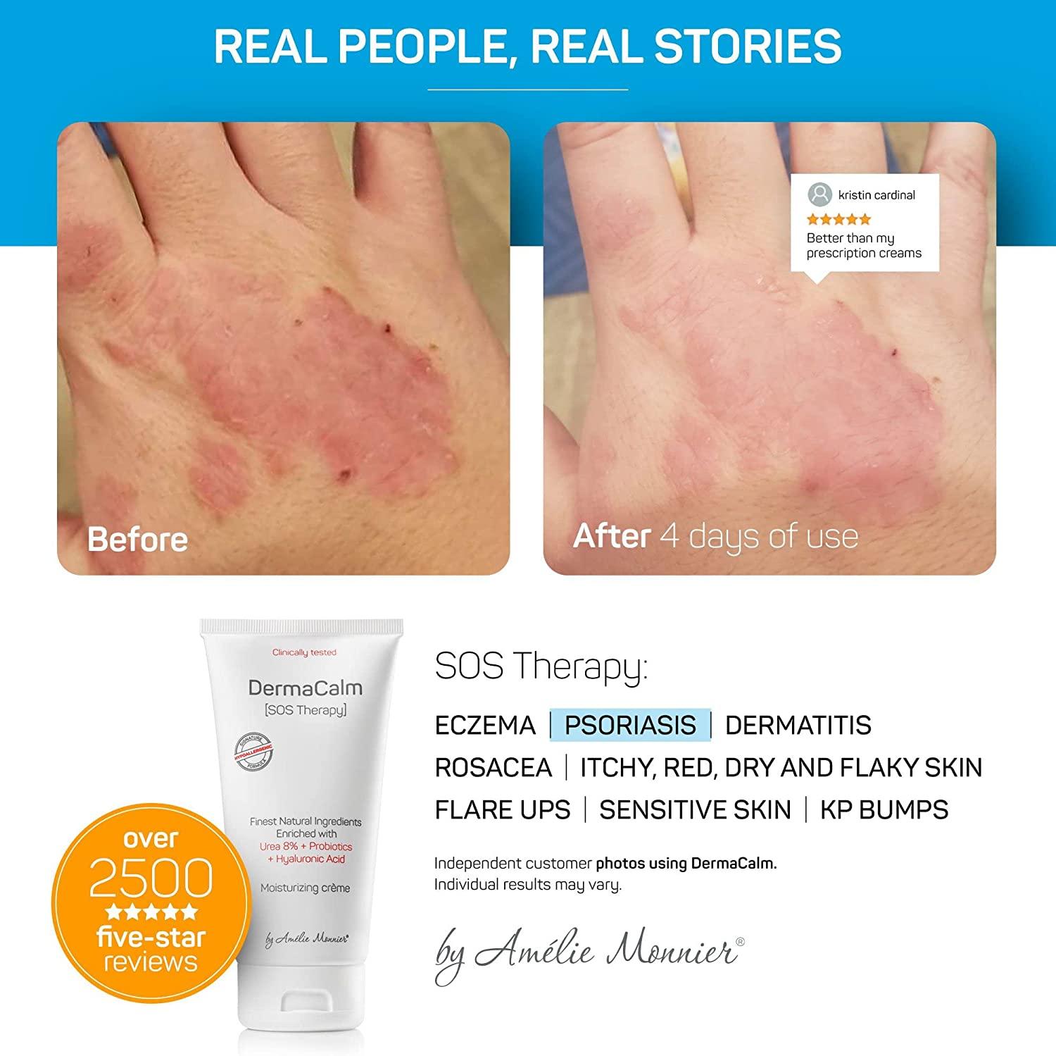 Clinically Tested Cream for Eczema, Dermatitis and Psoriasis Treatment